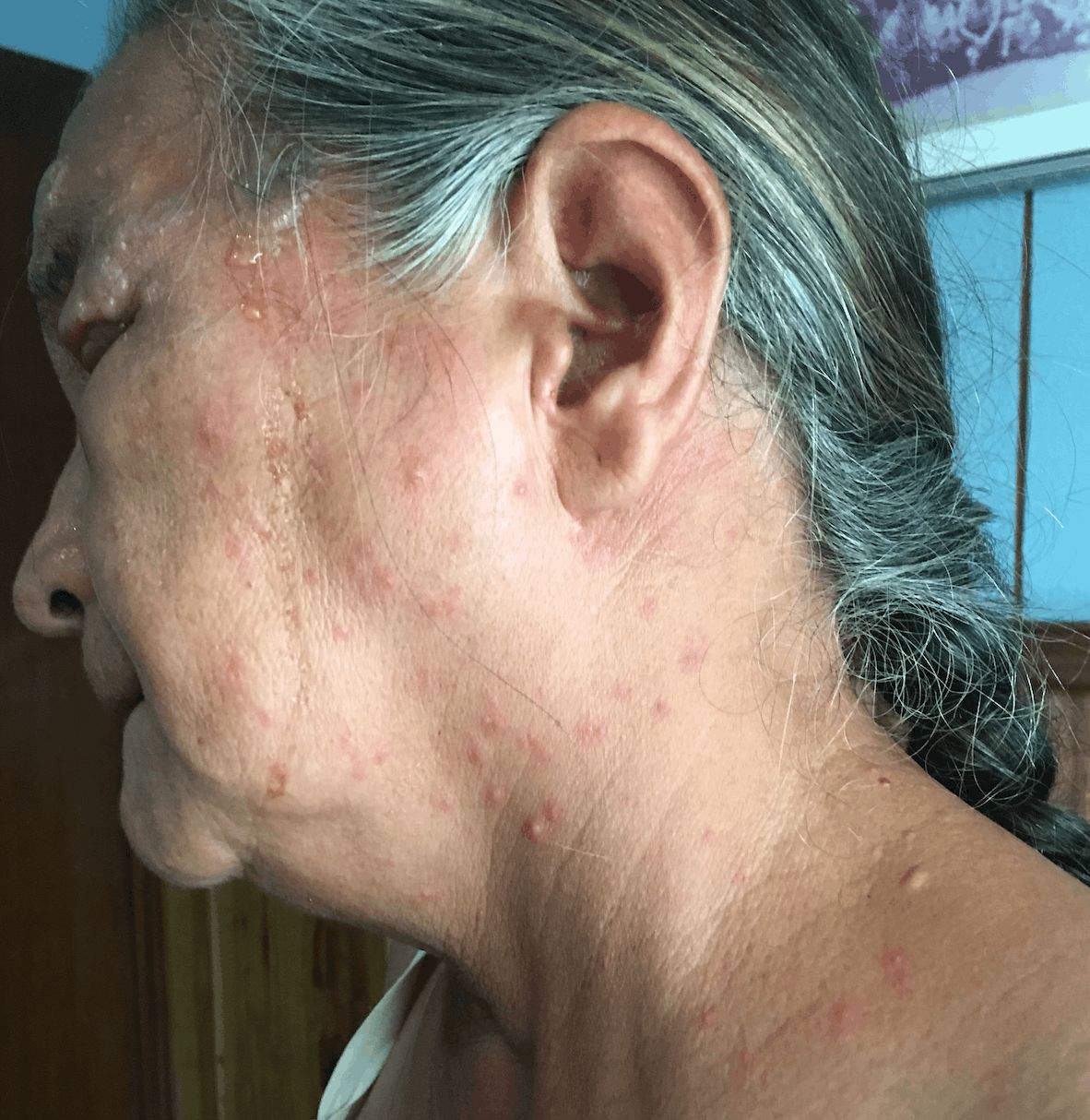HERPES ZOSTER