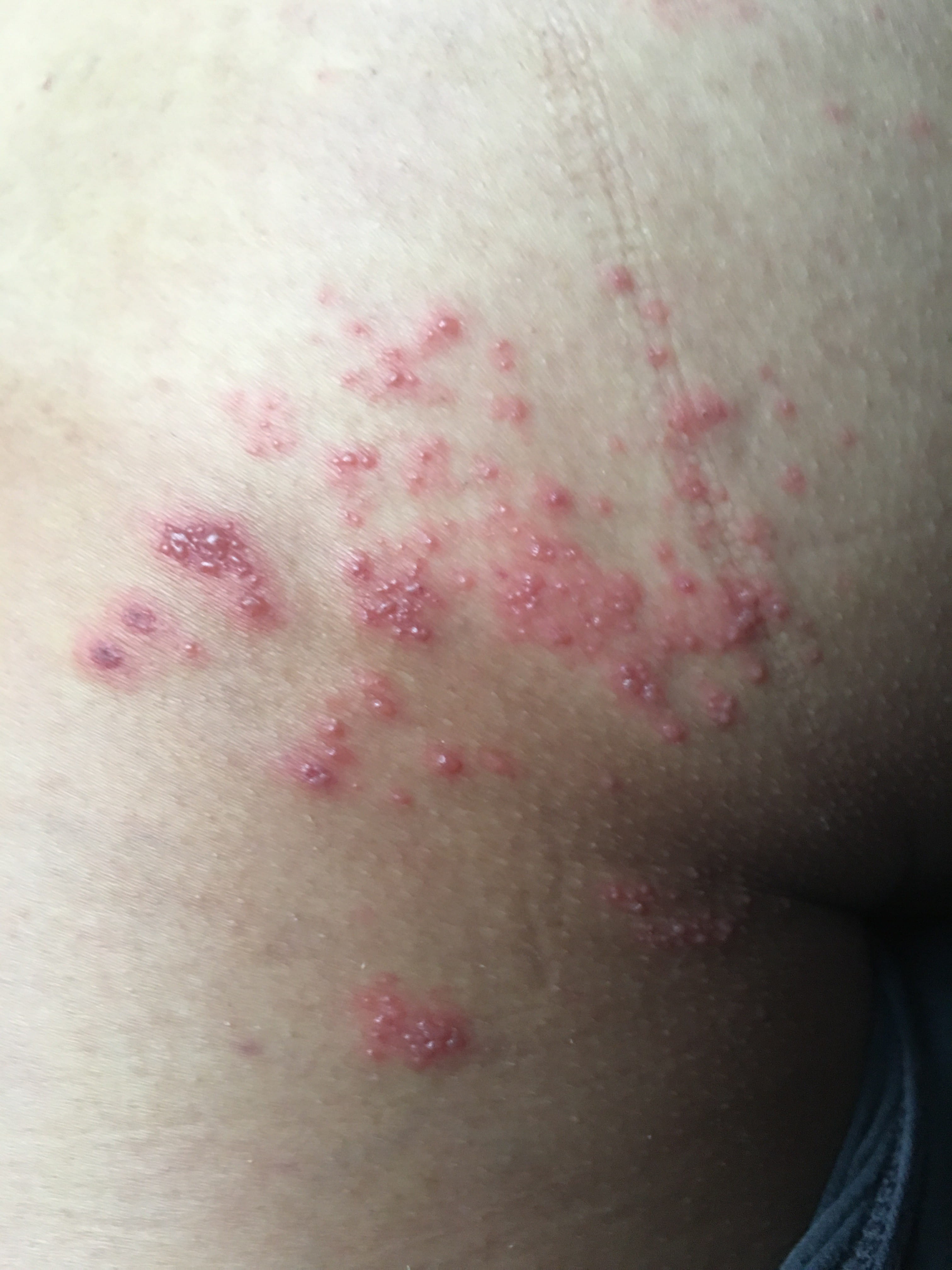 HERPES SIMPLE RECIDIVANTE