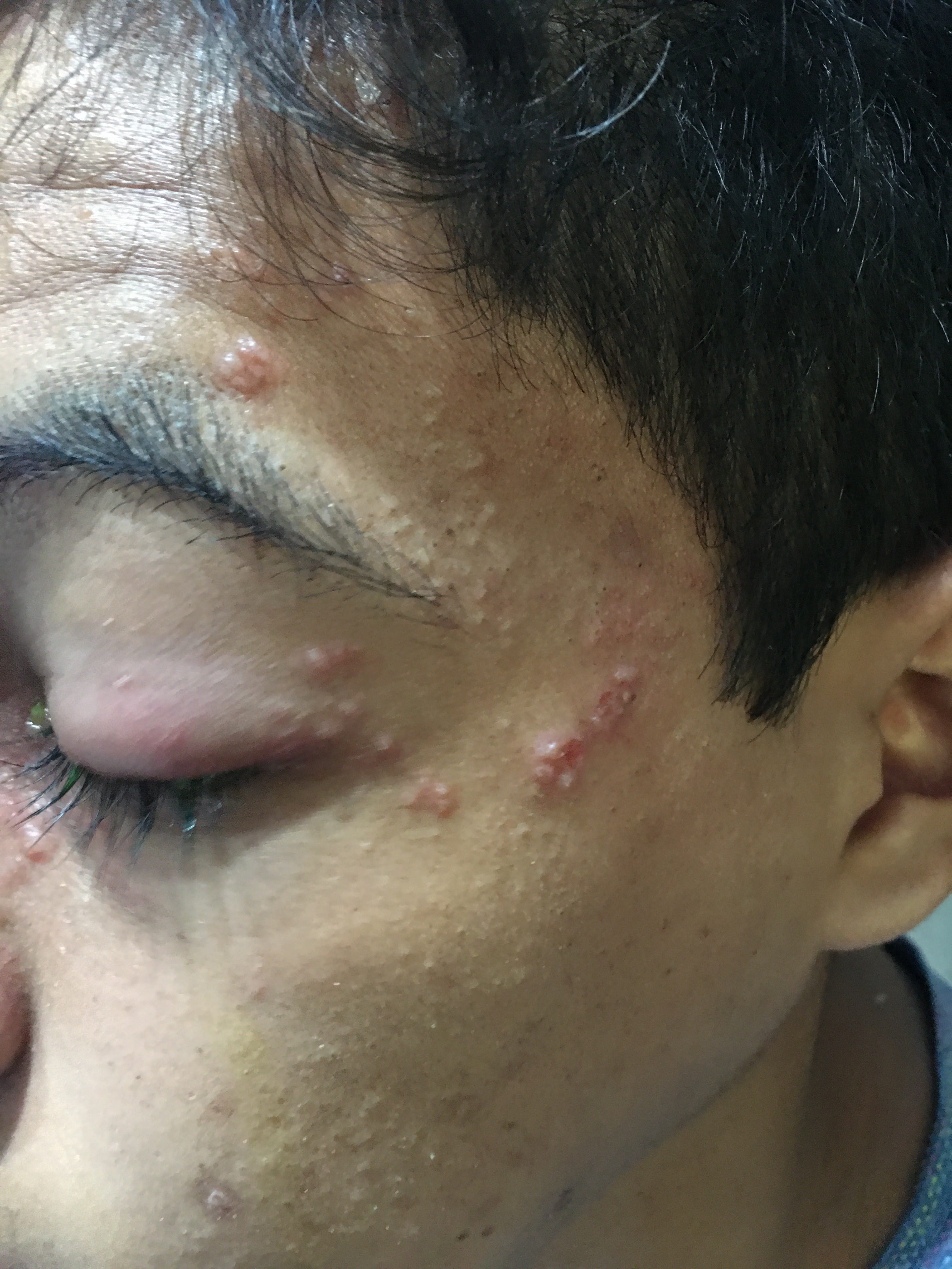 HERPES ZOSTER FACIAL
