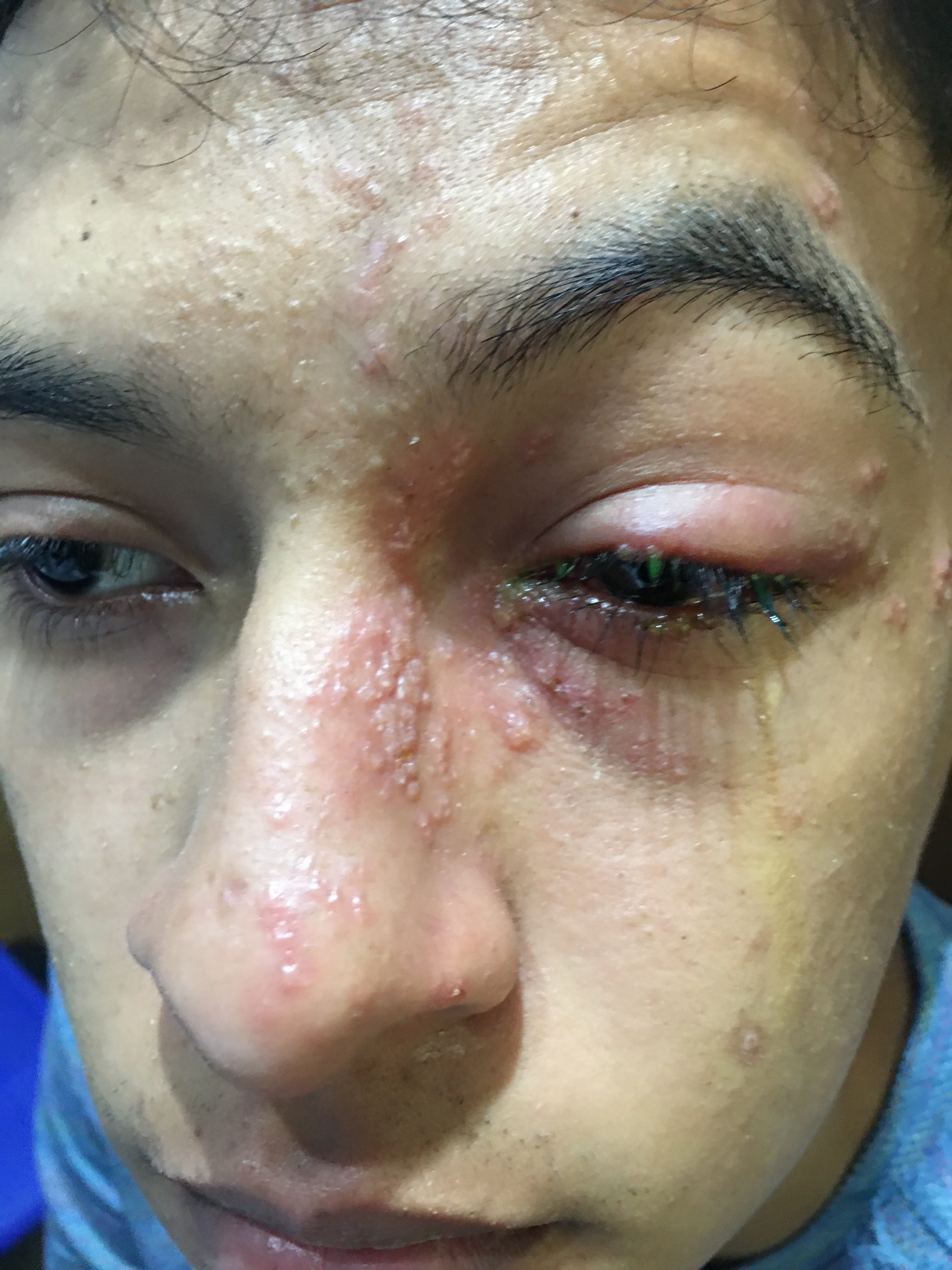 HERPES ZOSTER FACIAL