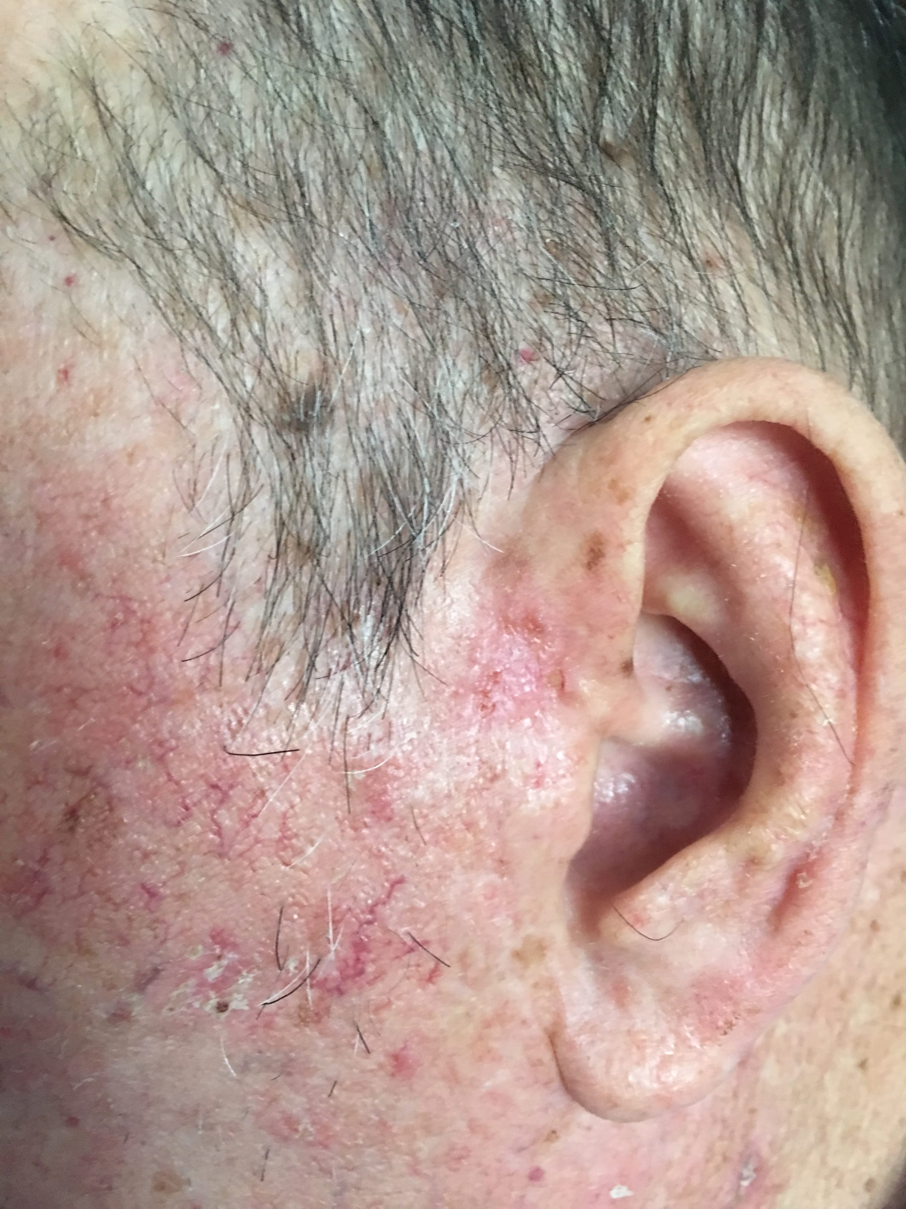 QUERATOSIS ACTINICAS
