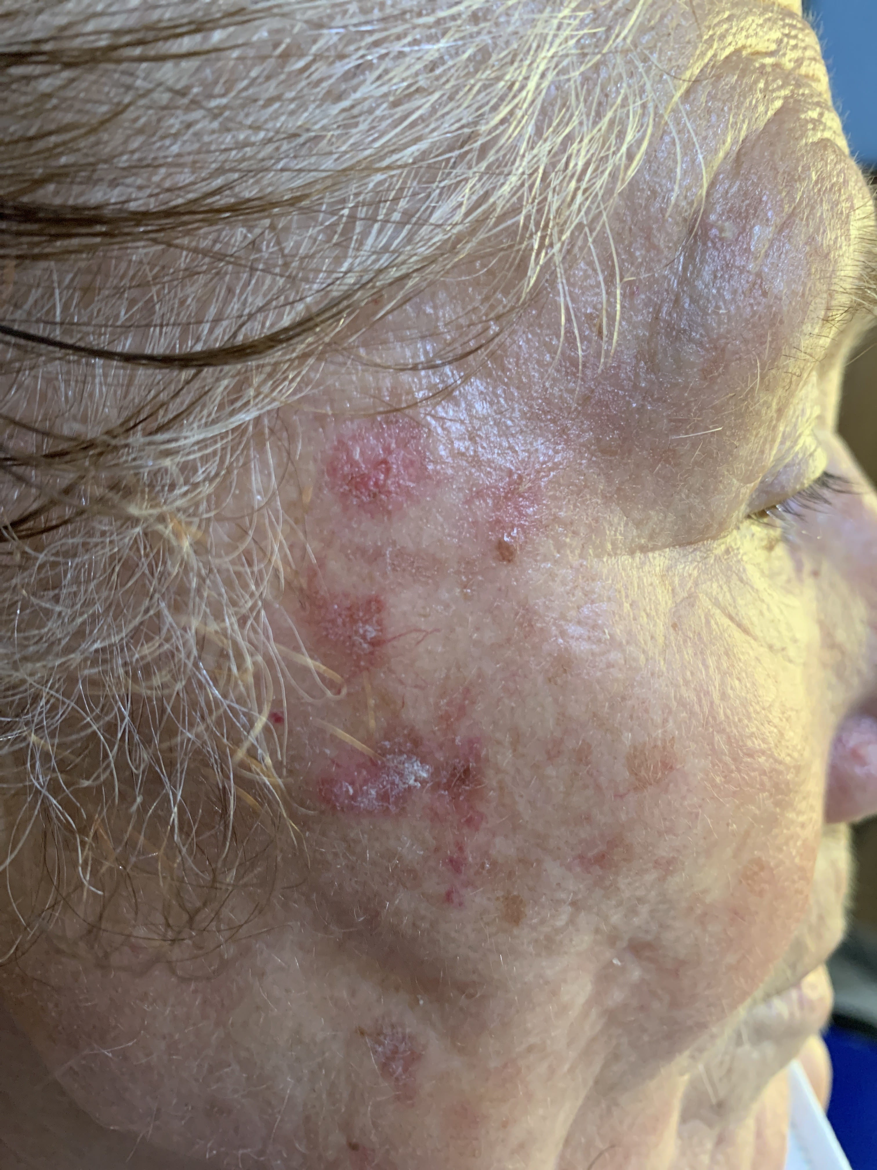 QUERATOSIS ACTINICAS