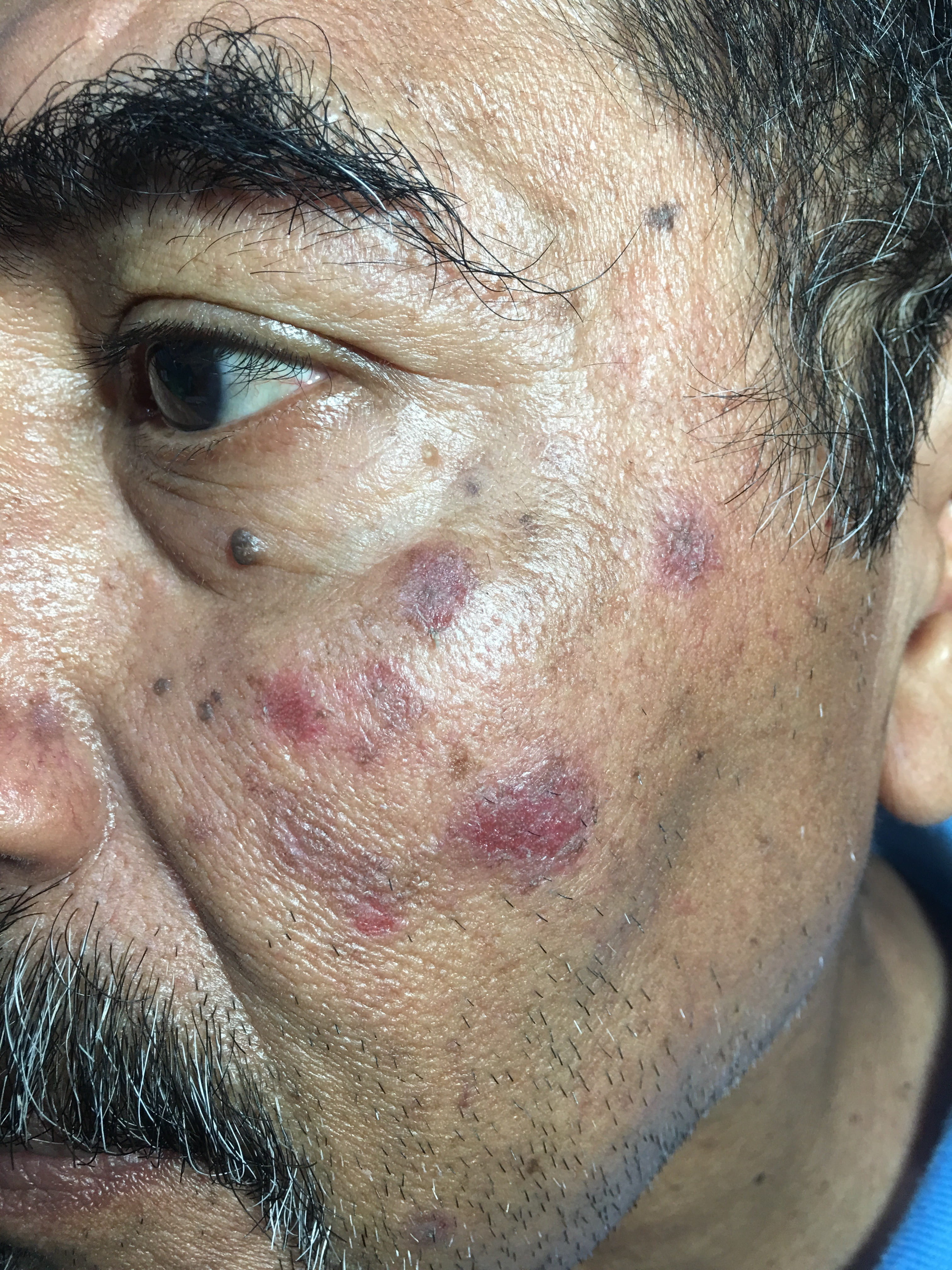 QUERATOSIS ACTINICAS