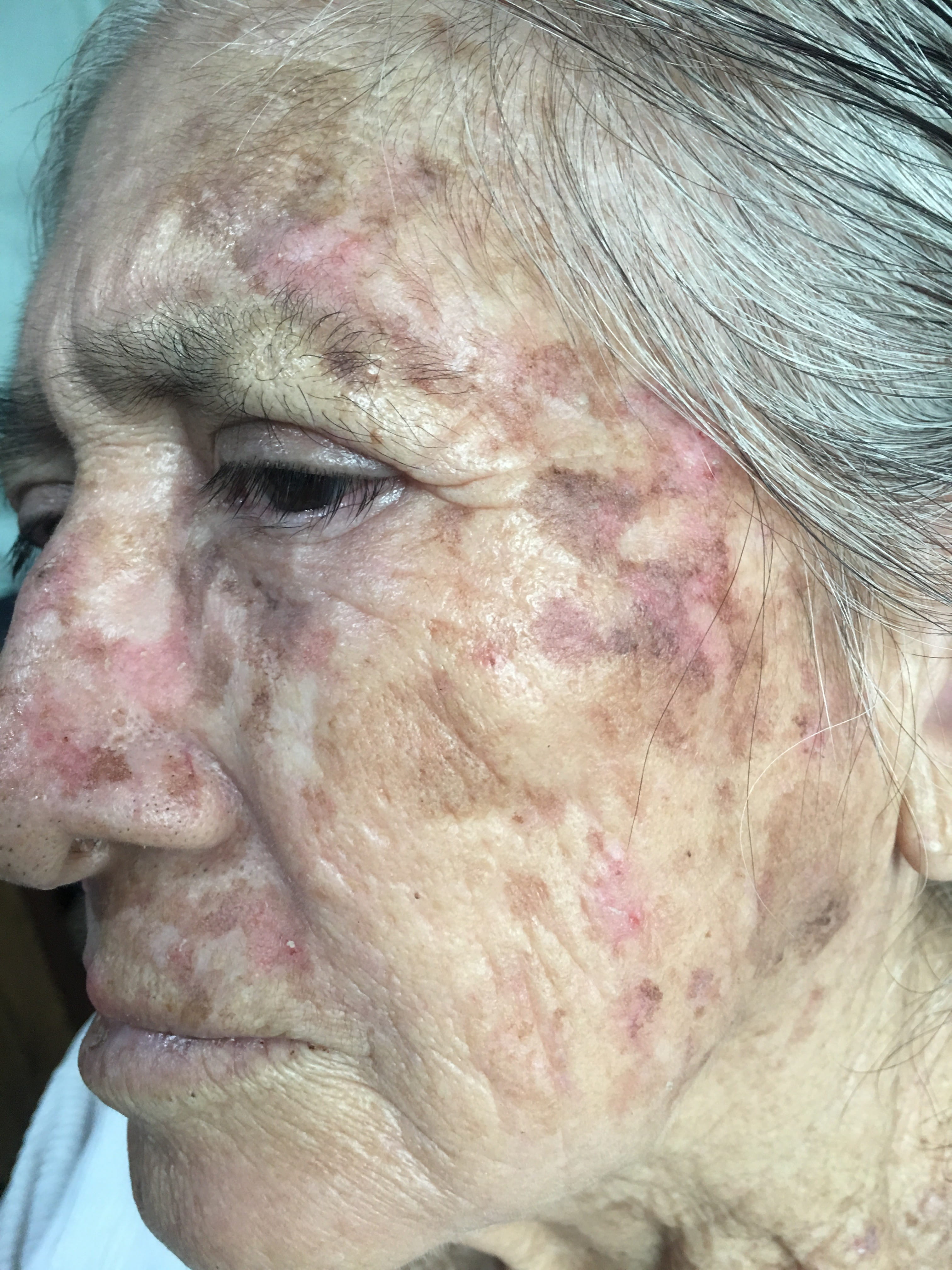 QUERATOSIS ACTINICAS