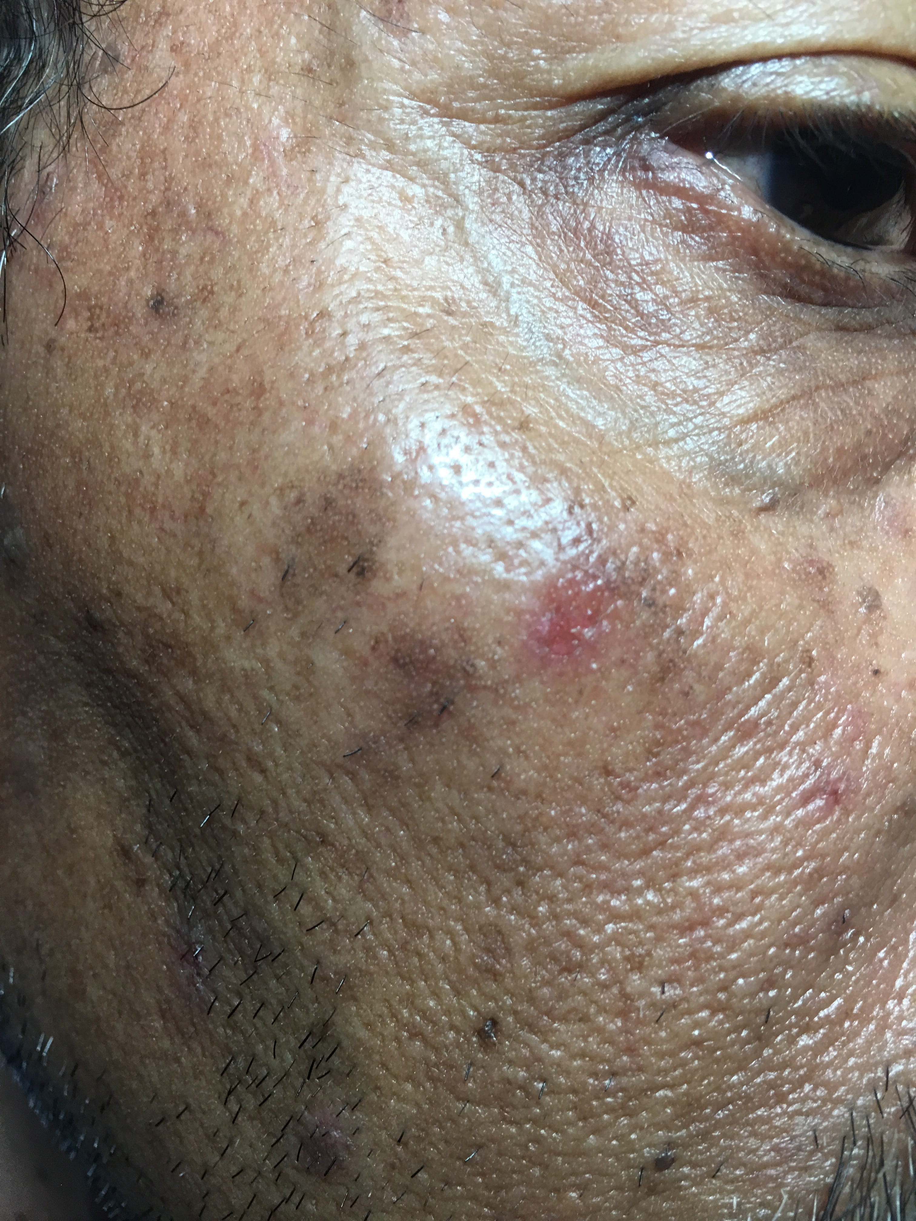 QUERATOSIS ACTINICAS