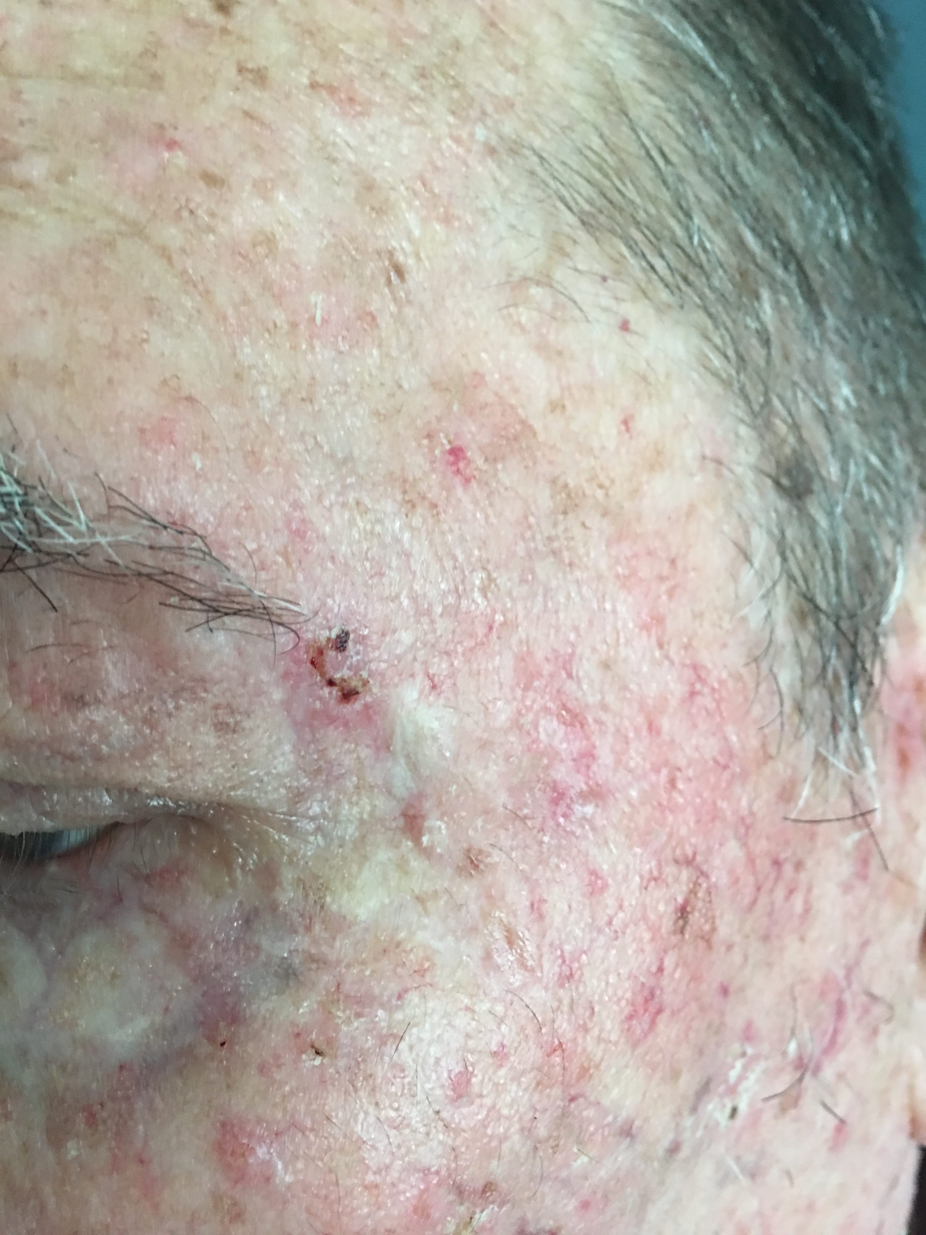 QUERATOSIS ACTINICAS