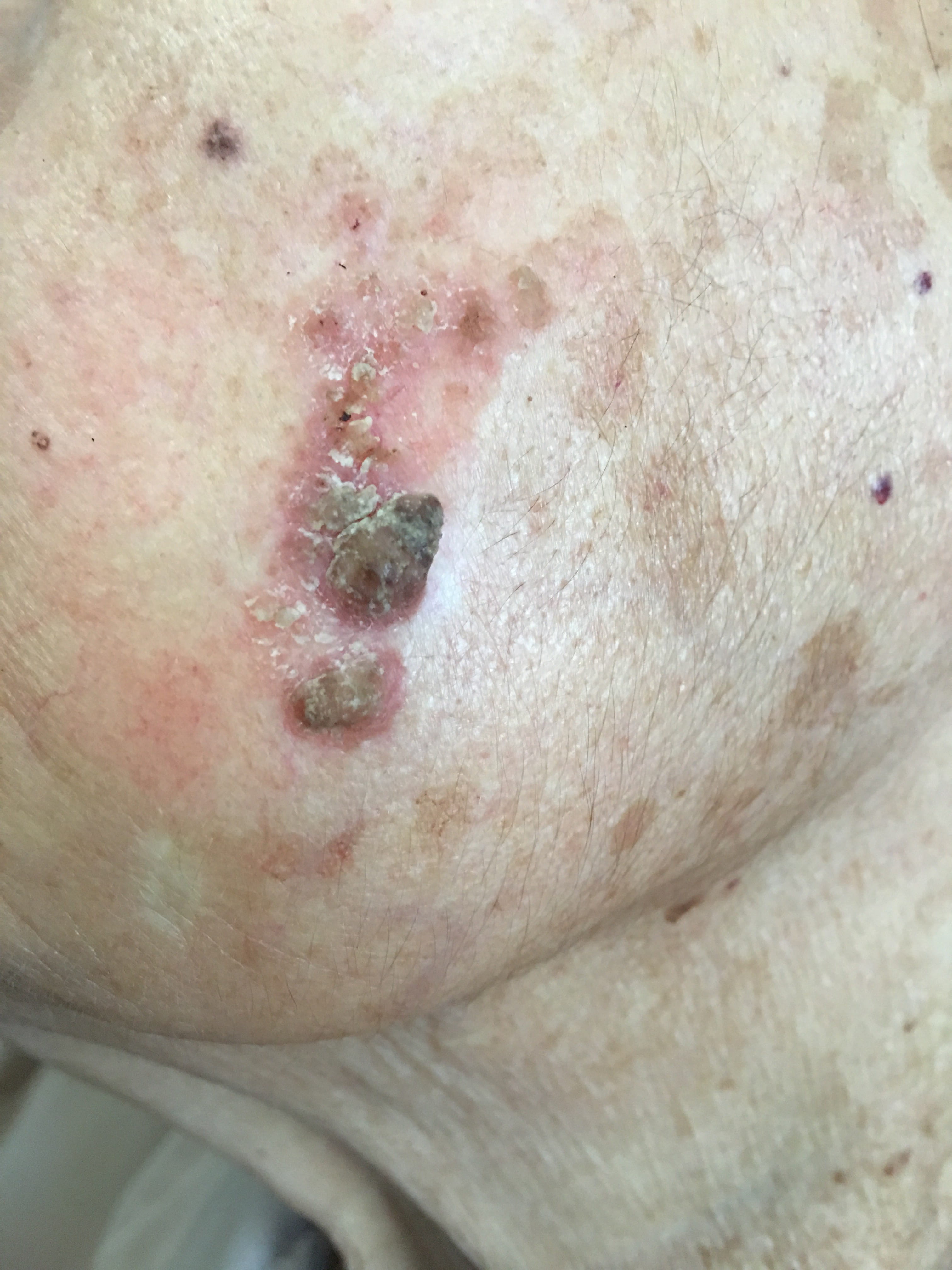 QUERATOSIS ACTINICAS y Queratosis Seborreica