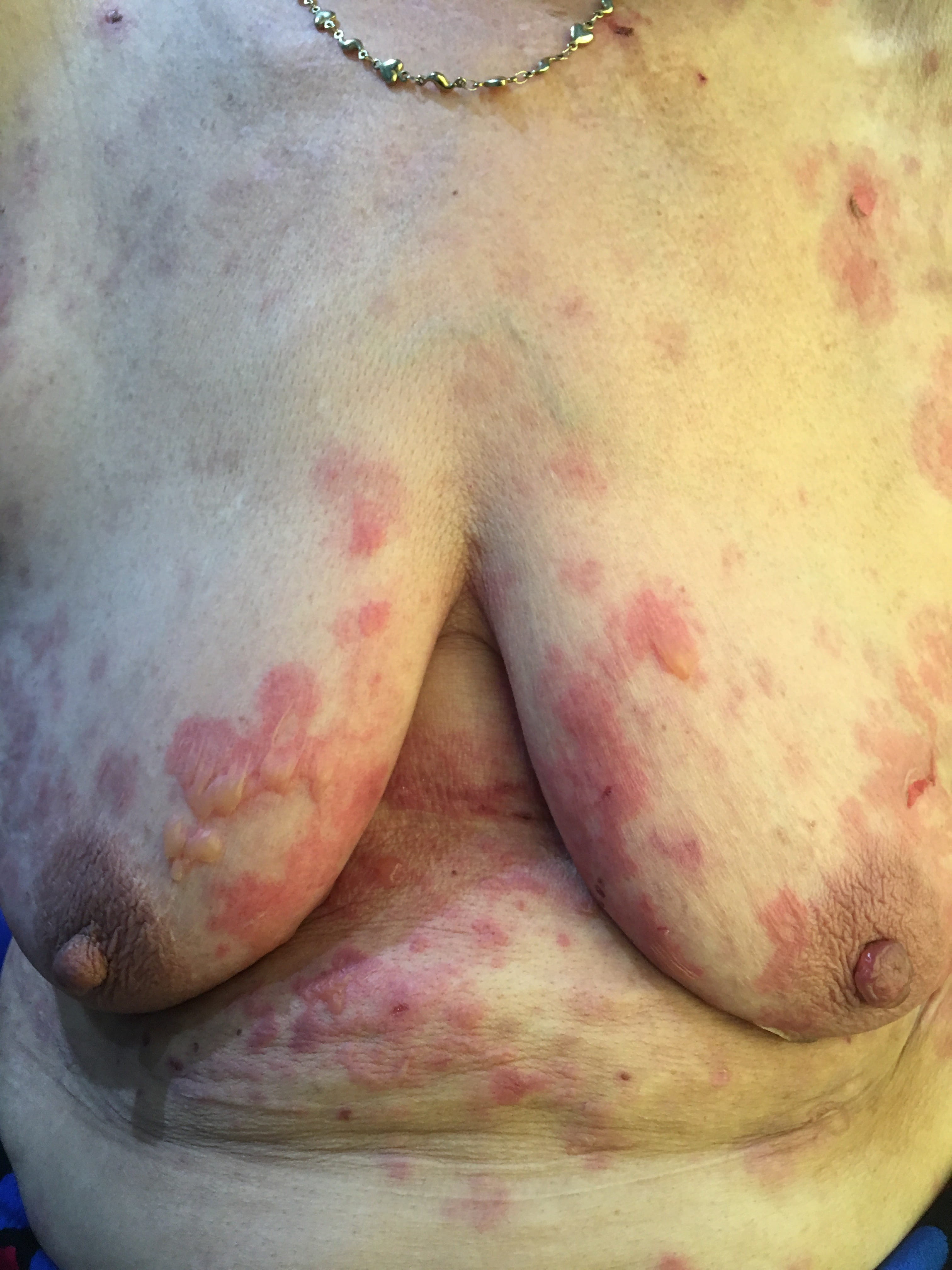 PENFIGOIDE AMPOLLOSO