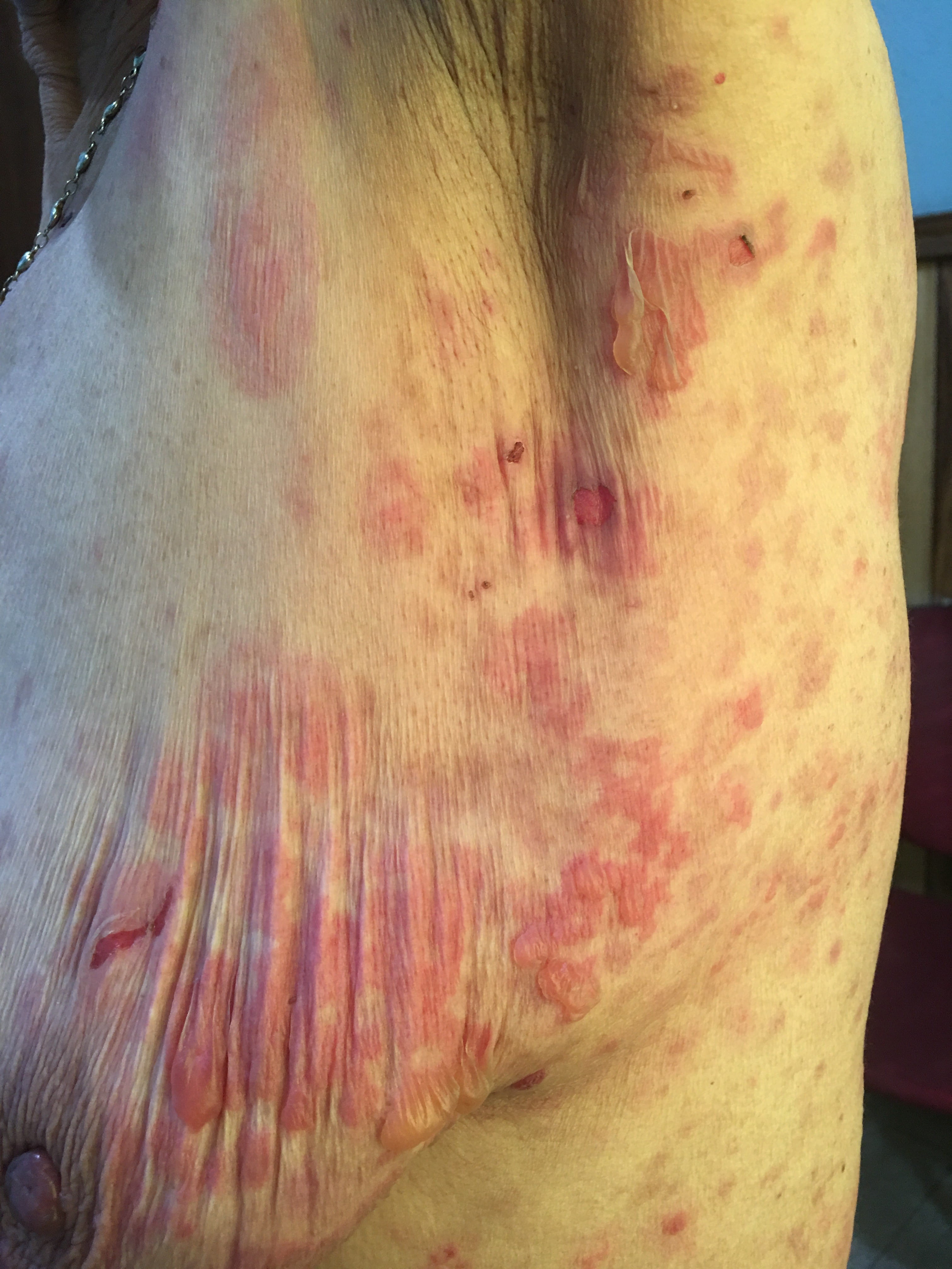 PENFIGOIDE AMPOLLOSO