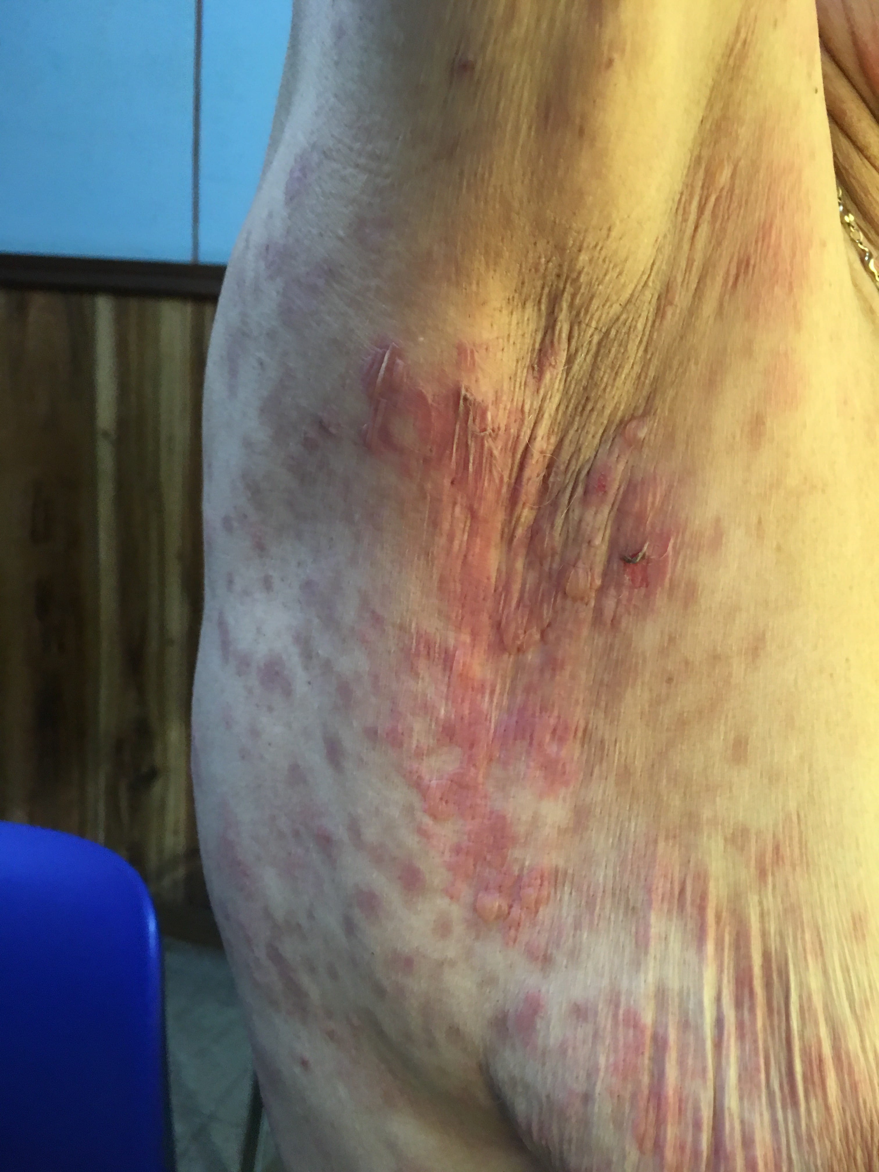 PENFIGOIDE AMPOLLOSO