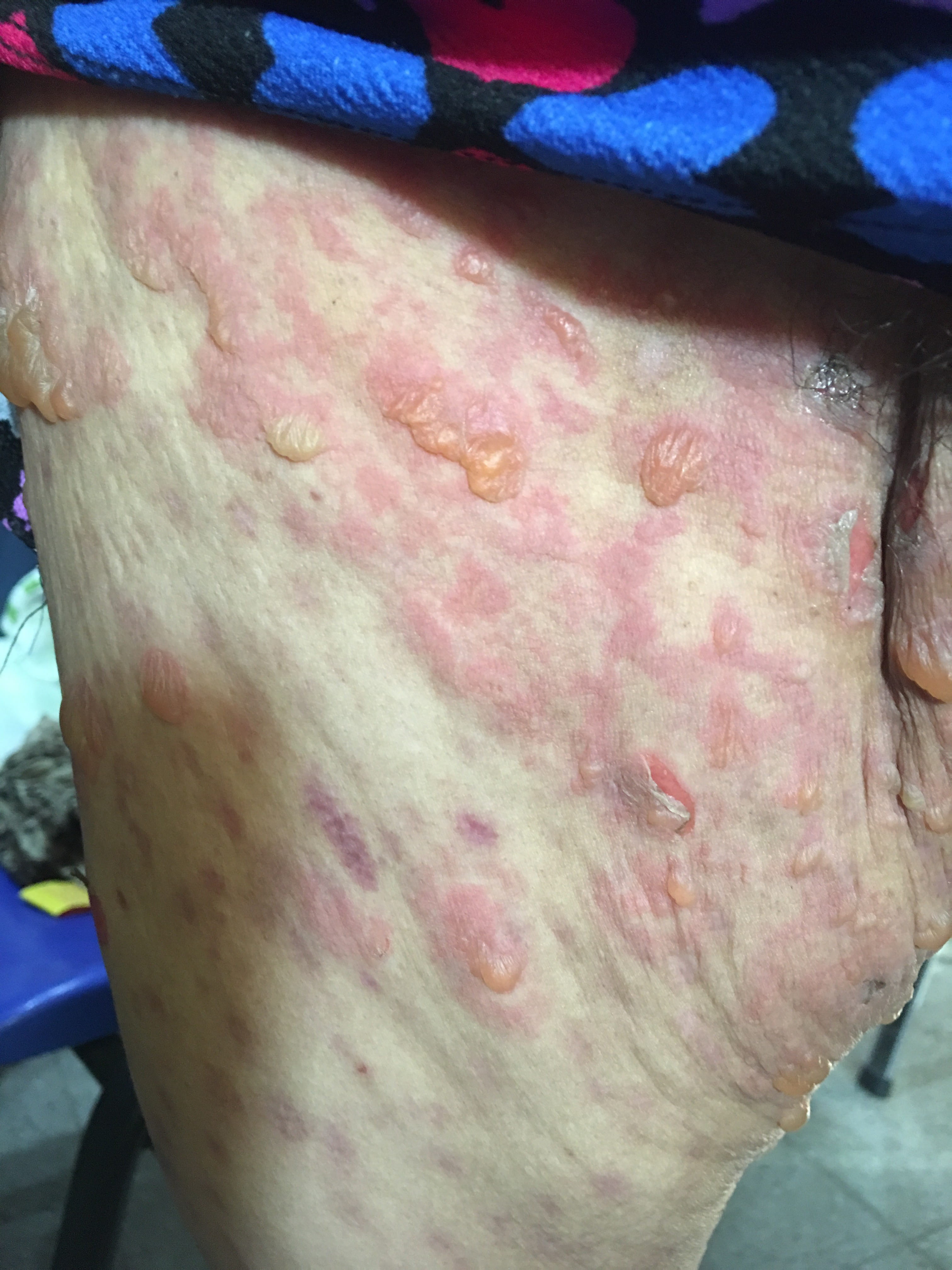 PENFIGOIDE AMPOLLOSO