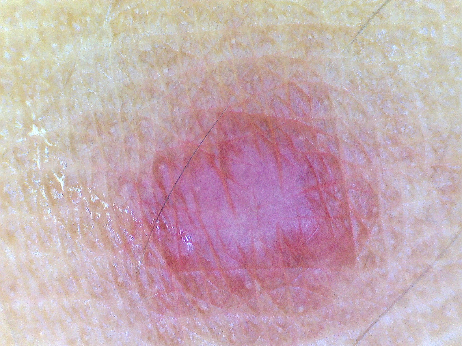 LEISHMANIASIS