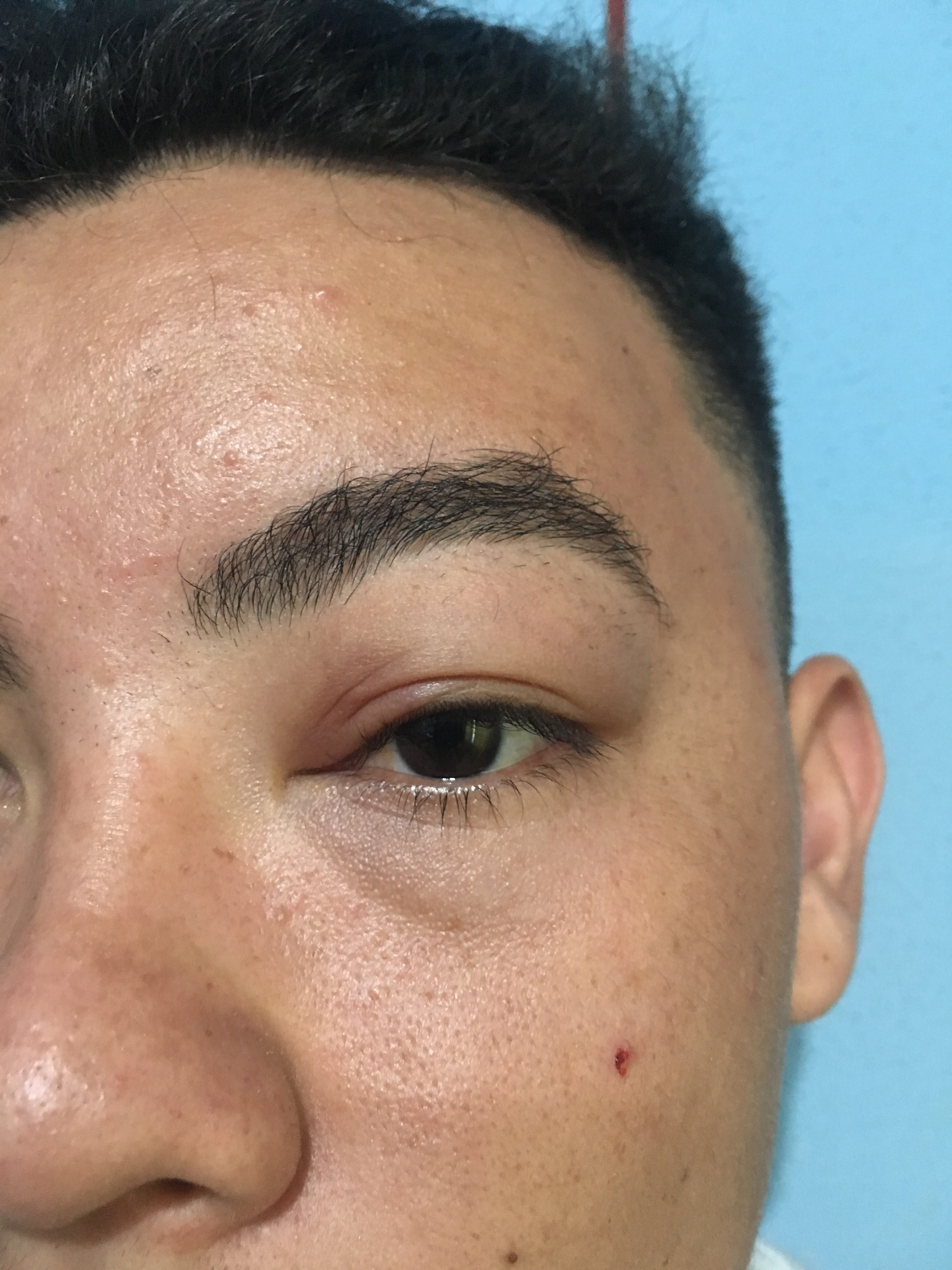 ANGIEDEMA DE PARPADO