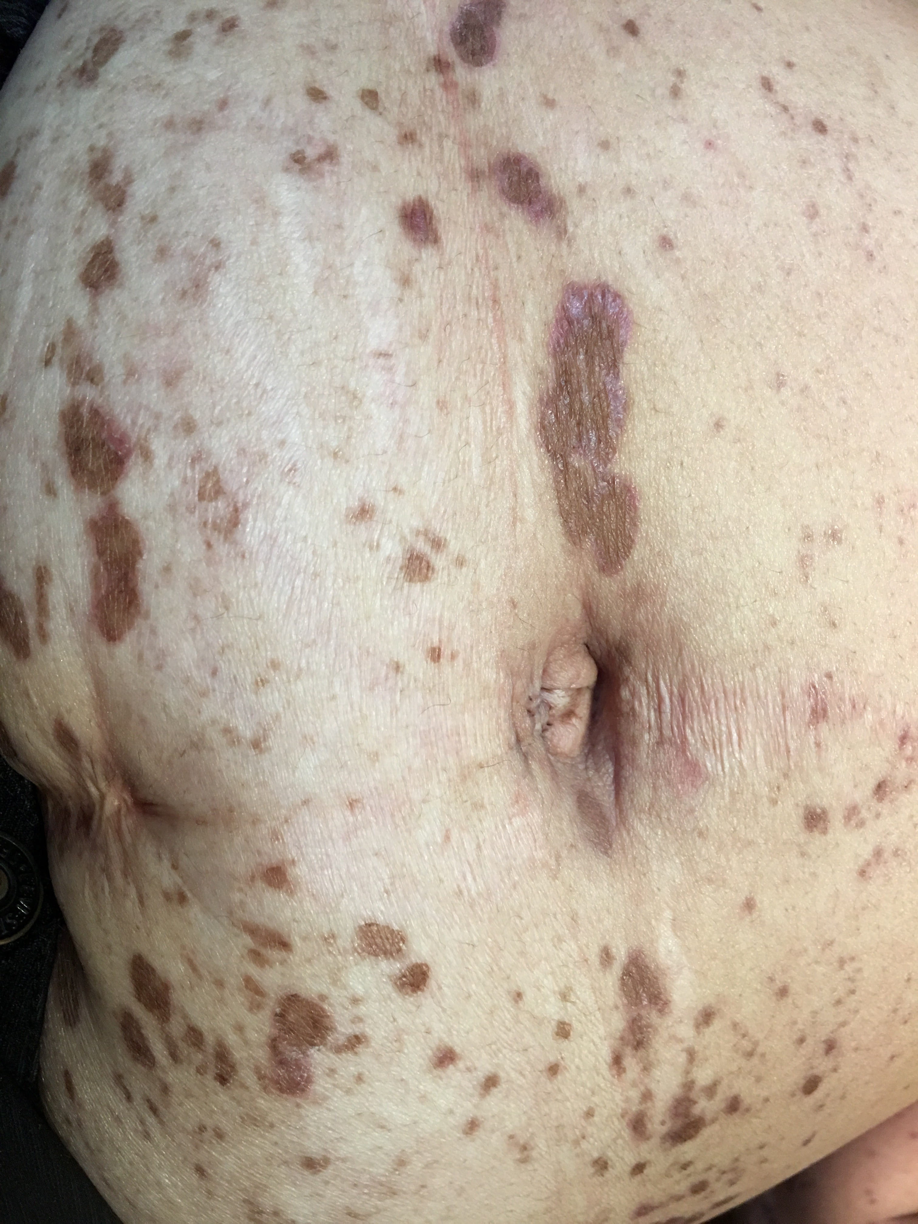 HIPERCROMIA POST LIQUEN PLANO