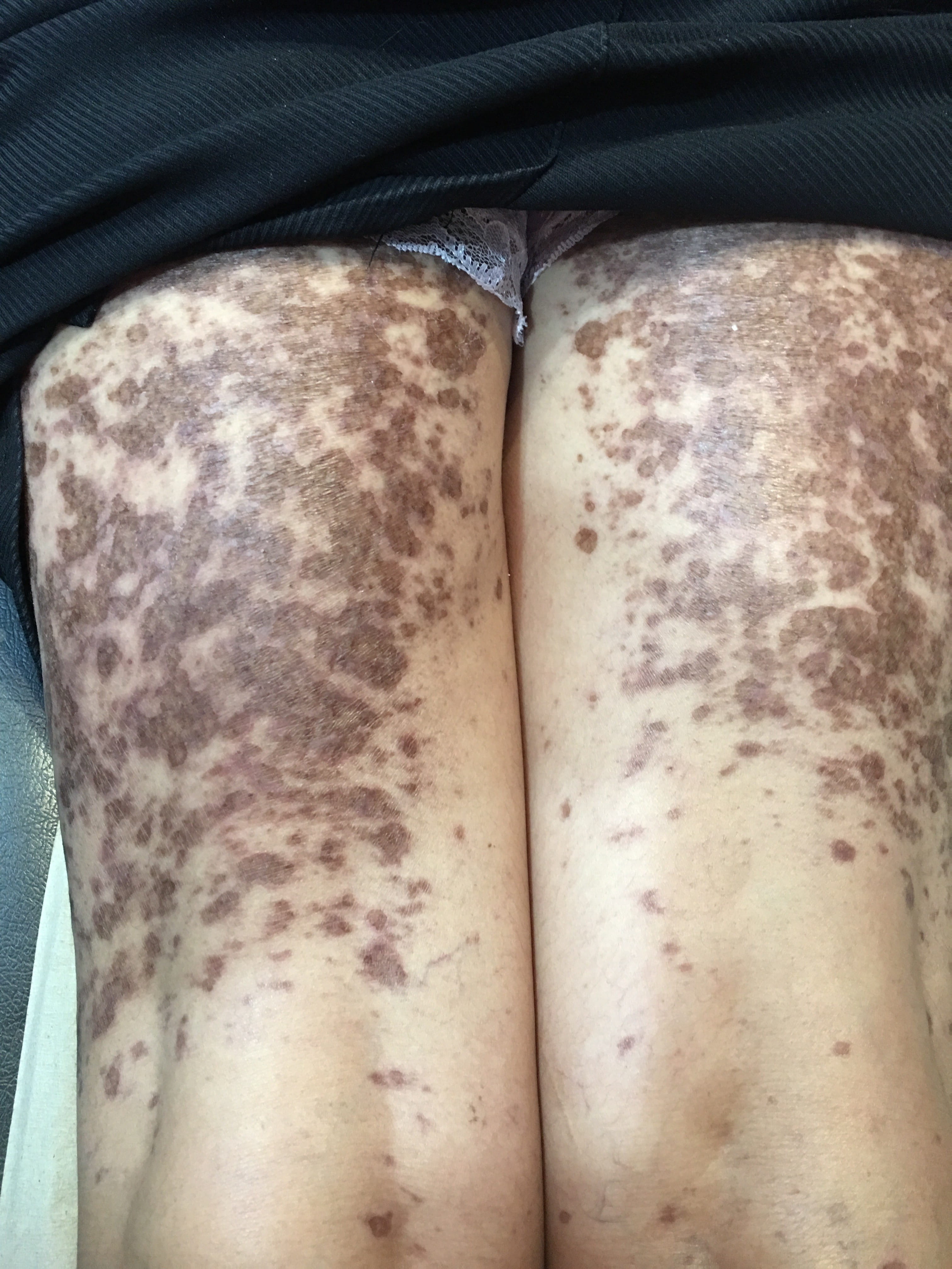 HIPERCROMIA POST LIQUEN PLANO