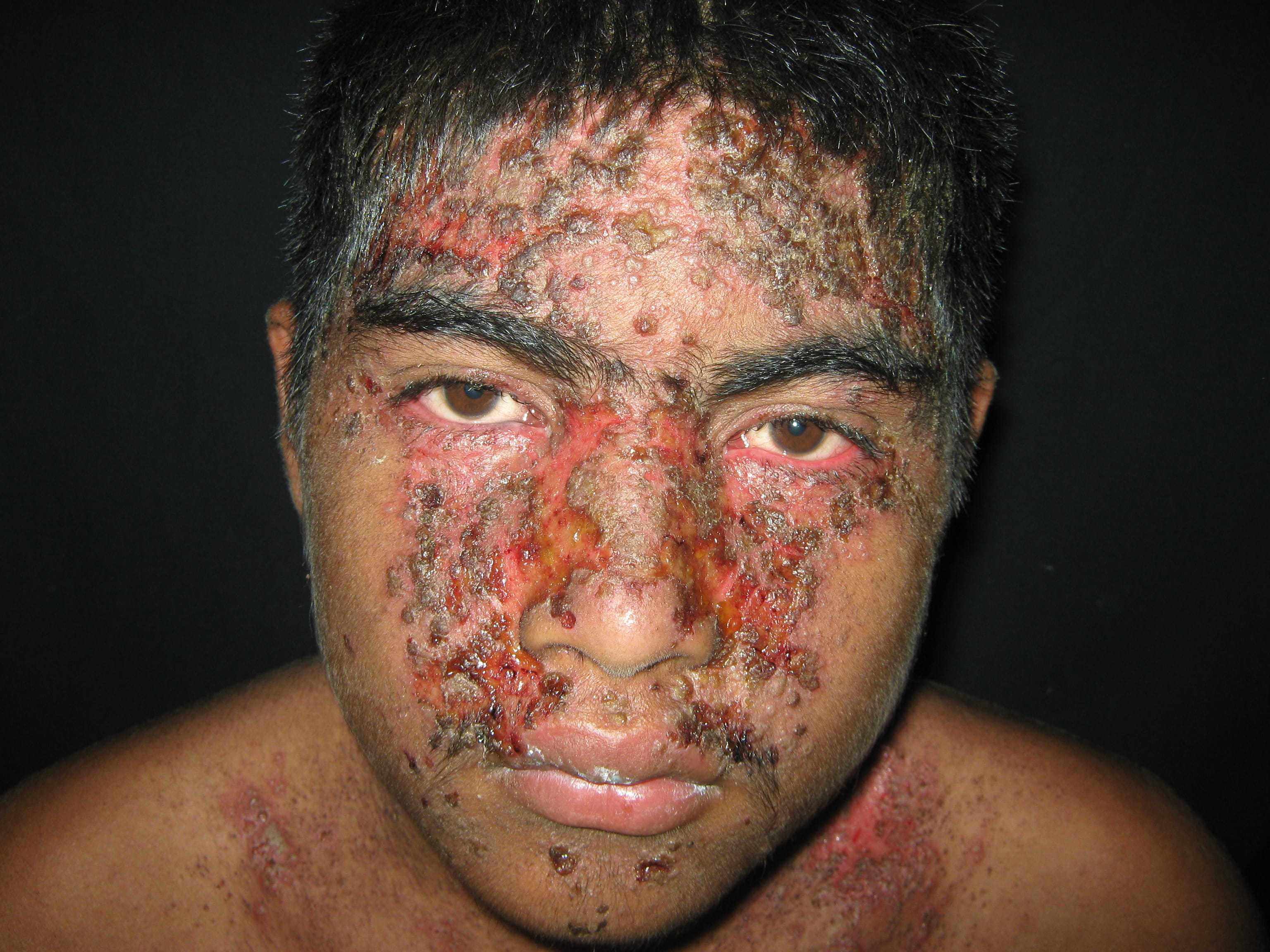 IMPETIGO - Enfermedad de Darier