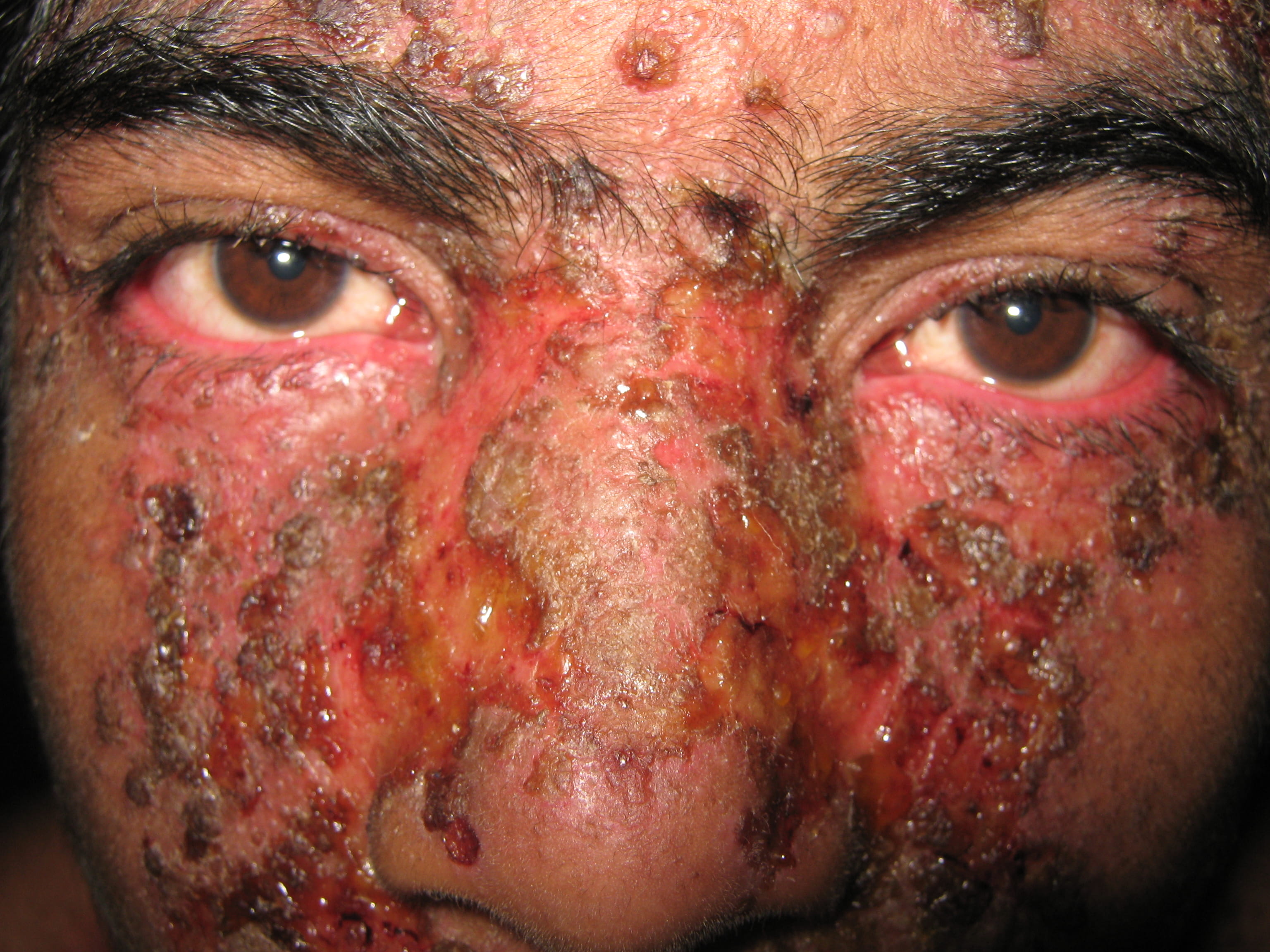 IMPETIGO - Enfermedad de Darier