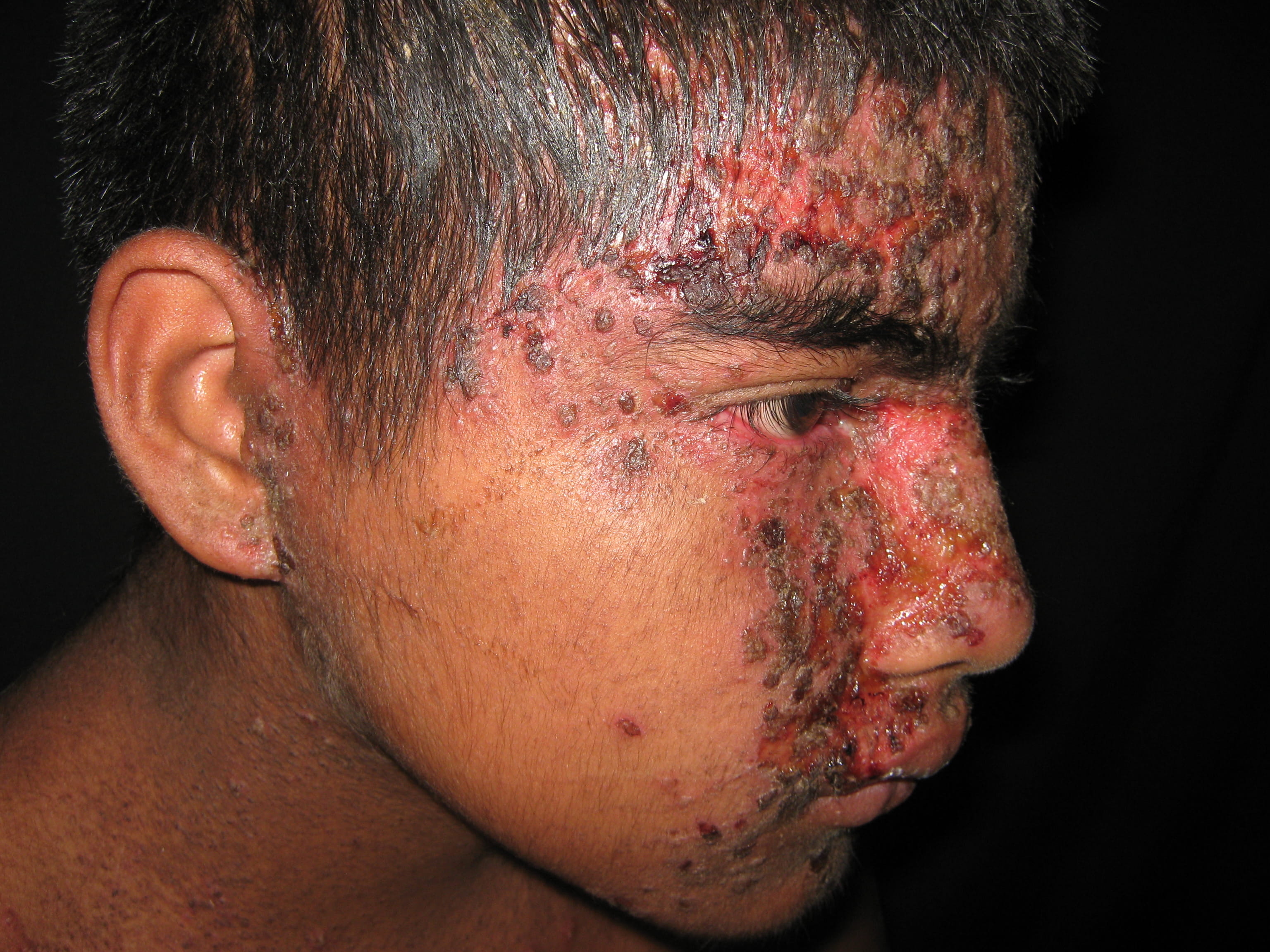 IMPETIGO - Enfermedad de Darier