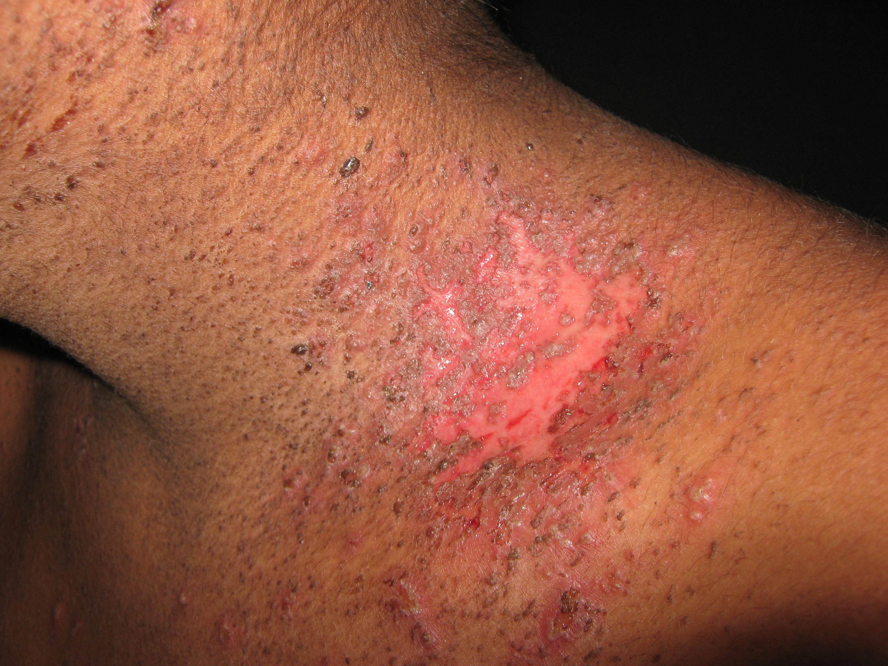 IMPETIGO - Enfermedad de Darier