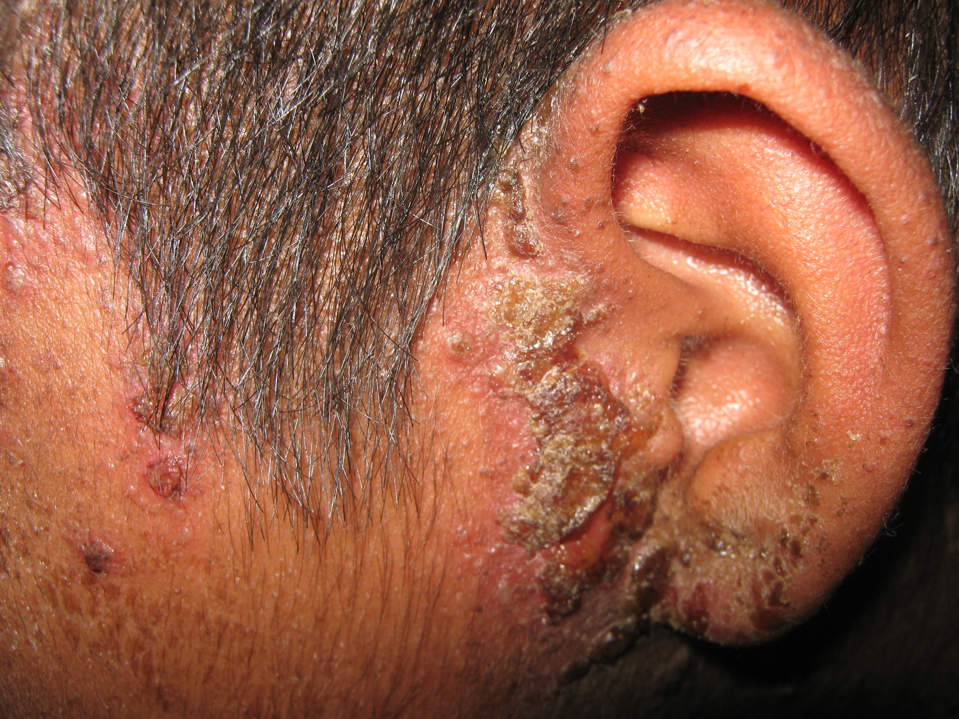 IMPETIGO - Enfermedad de Darier