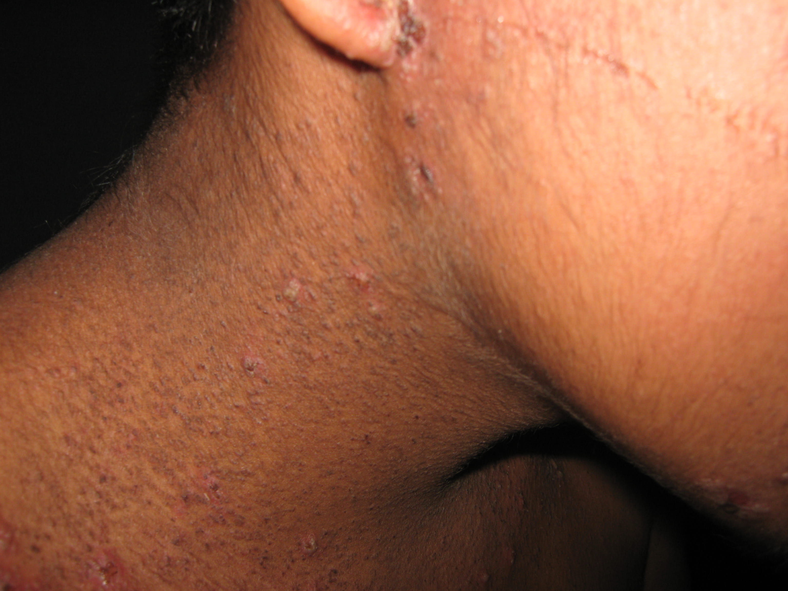 IMPETIGO - Enfermedad de Darier