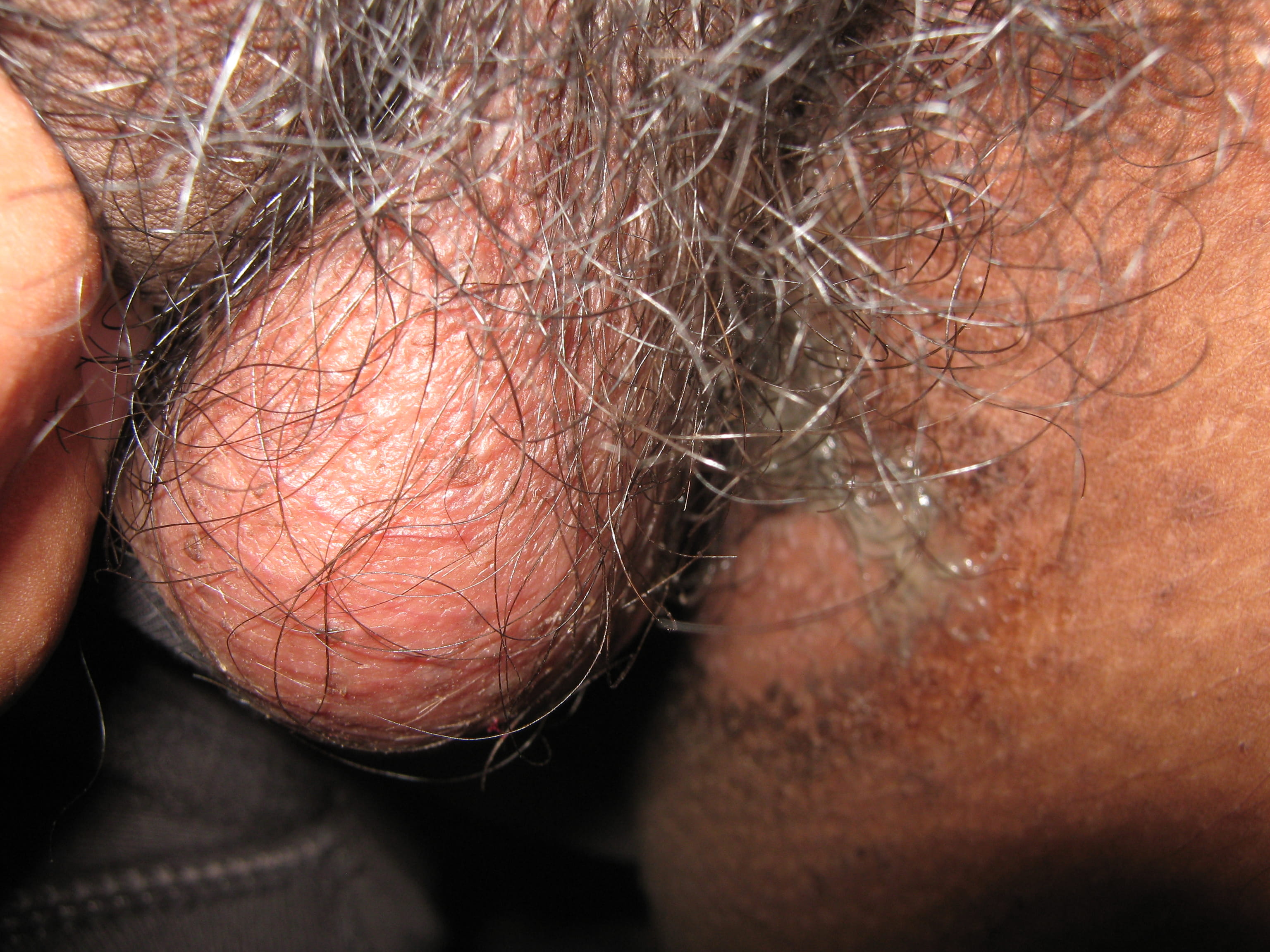 IMPETIGO - Enfermedad de Darier