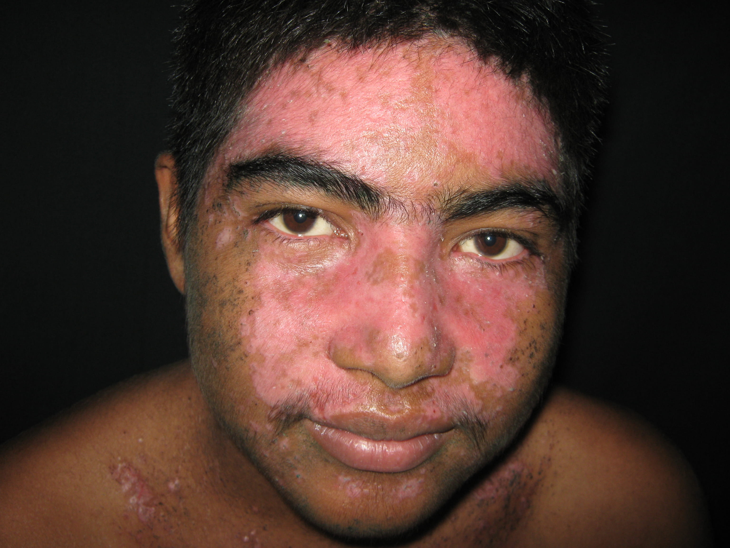 IMPETIGO - Enfermedad de Darier