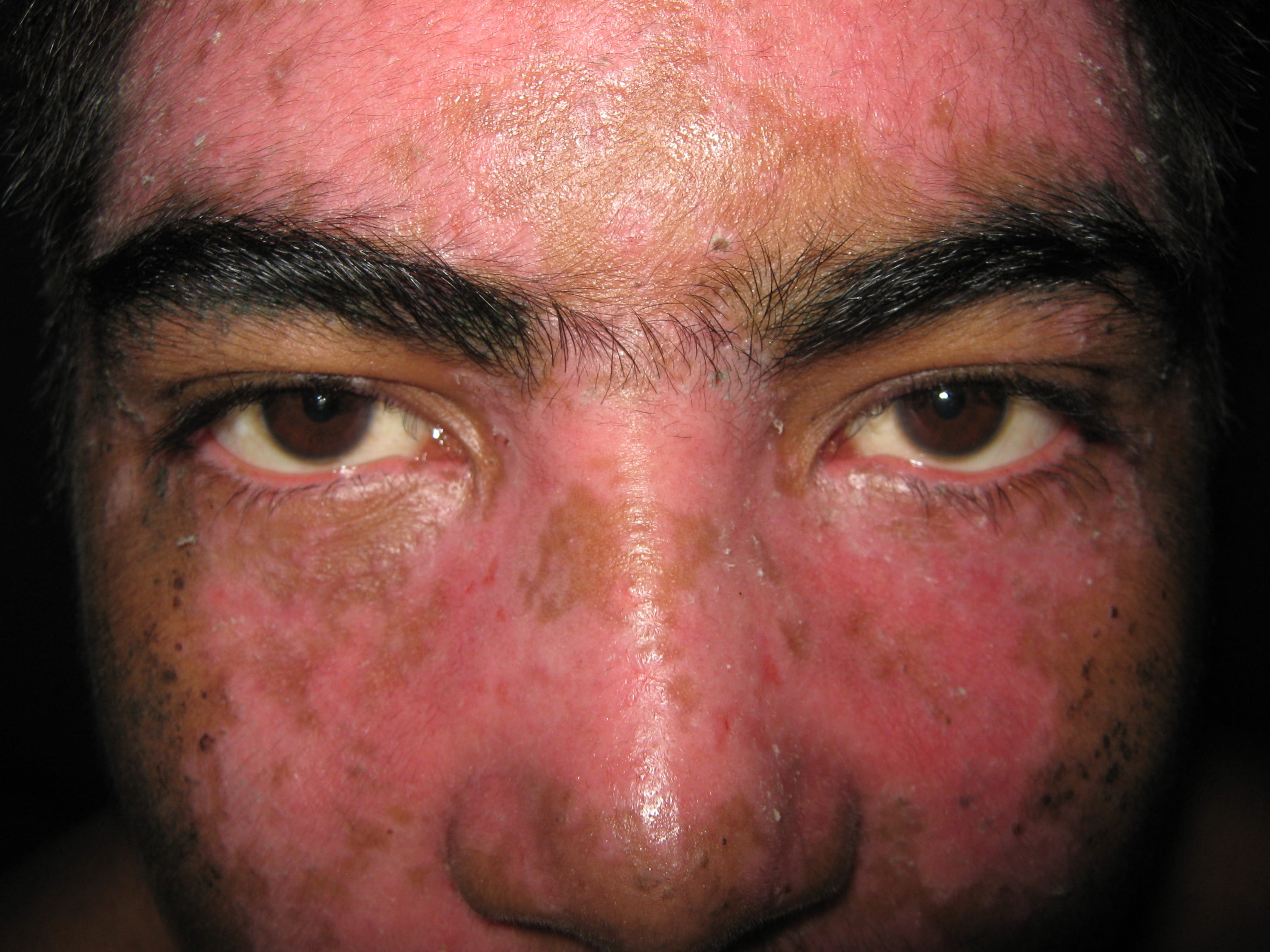 IMPETIGO - Enfermedad de Darier