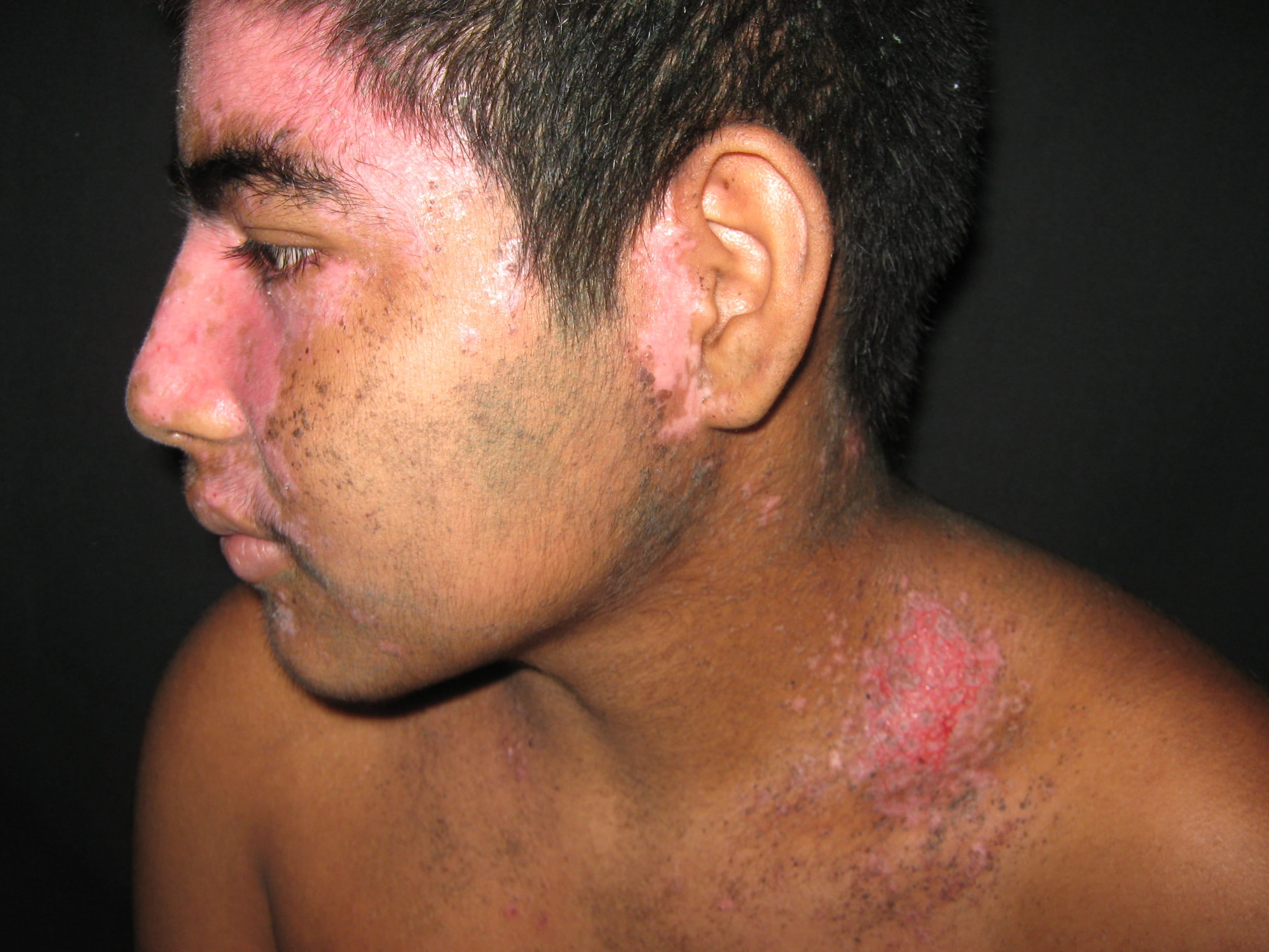 IMPETIGO - Enfermedad de Darier