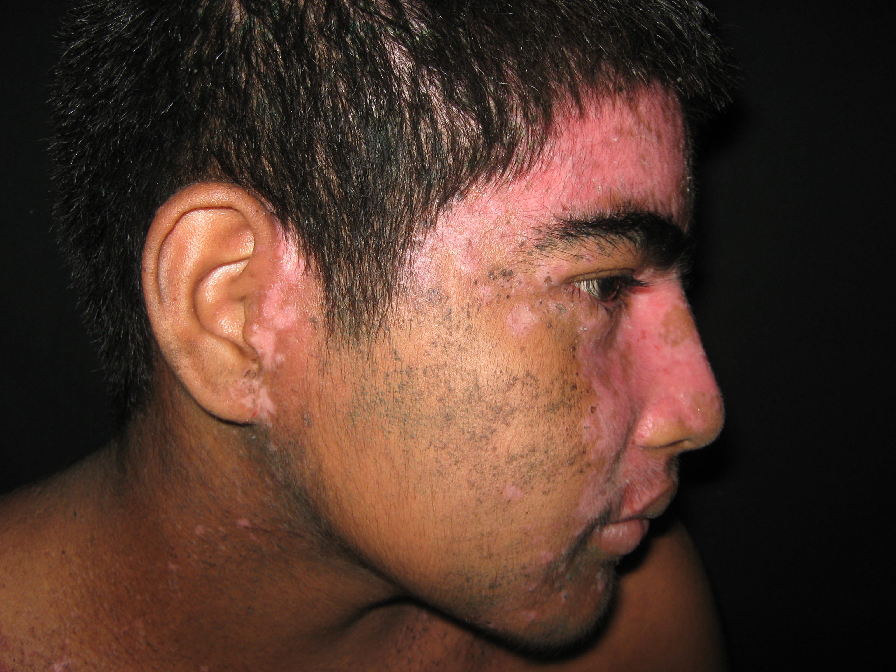 IMPETIGO - Enfermedad de Darier