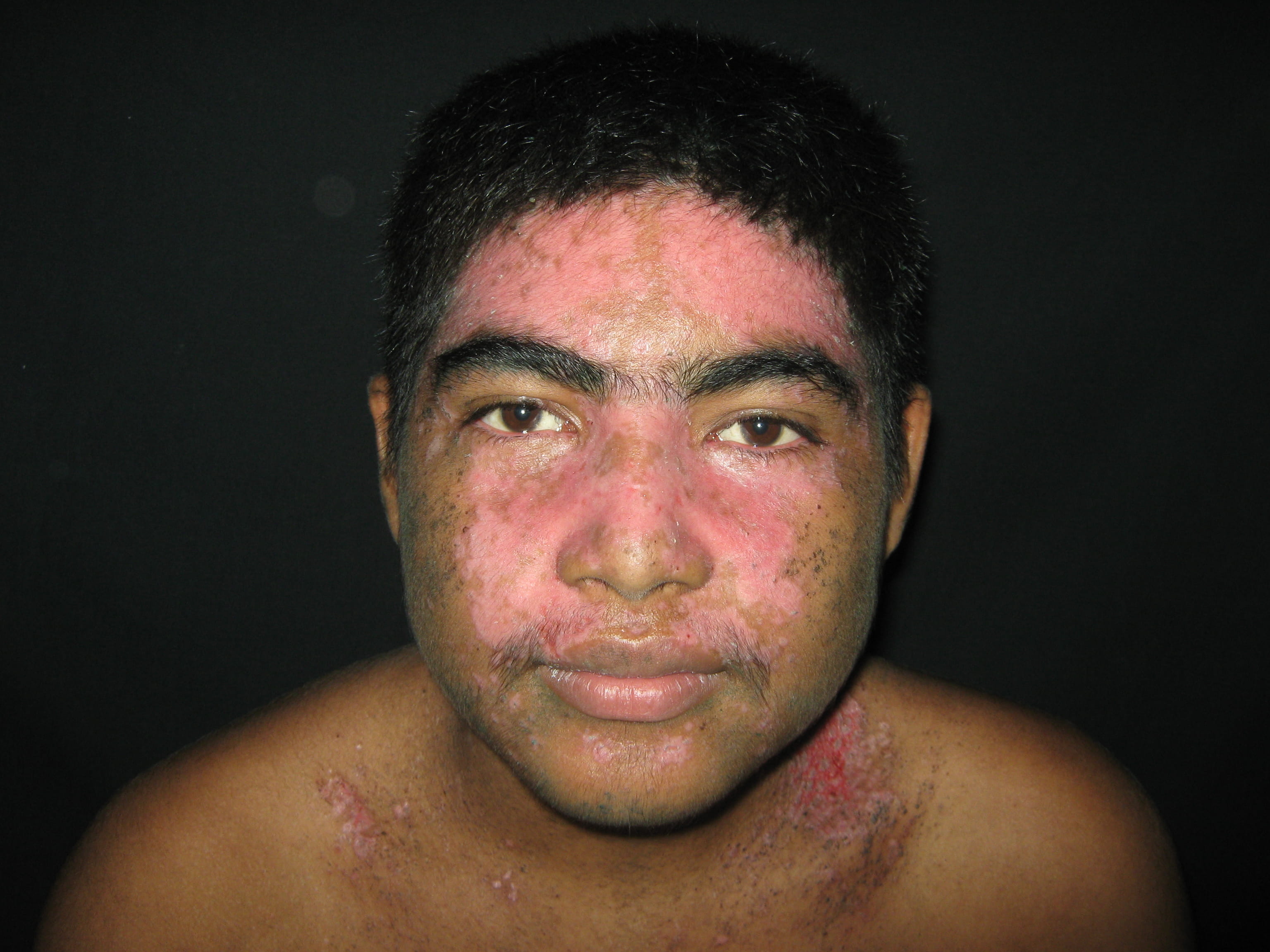 IMPETIGO - Enfermedad de Darier