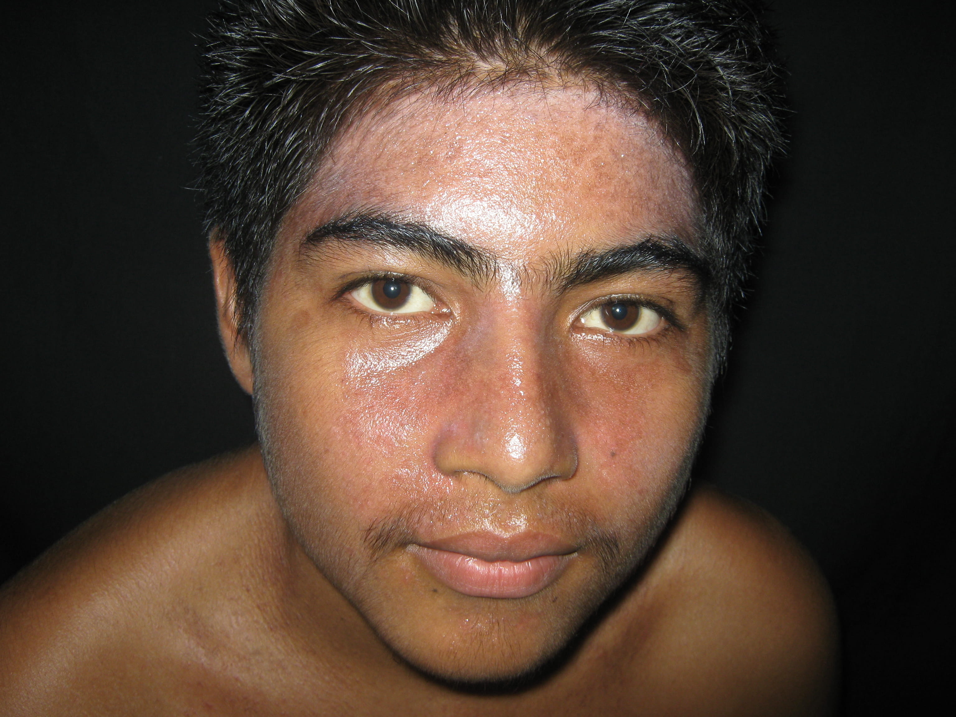 IMPETIGO - Enfermedad de Darier