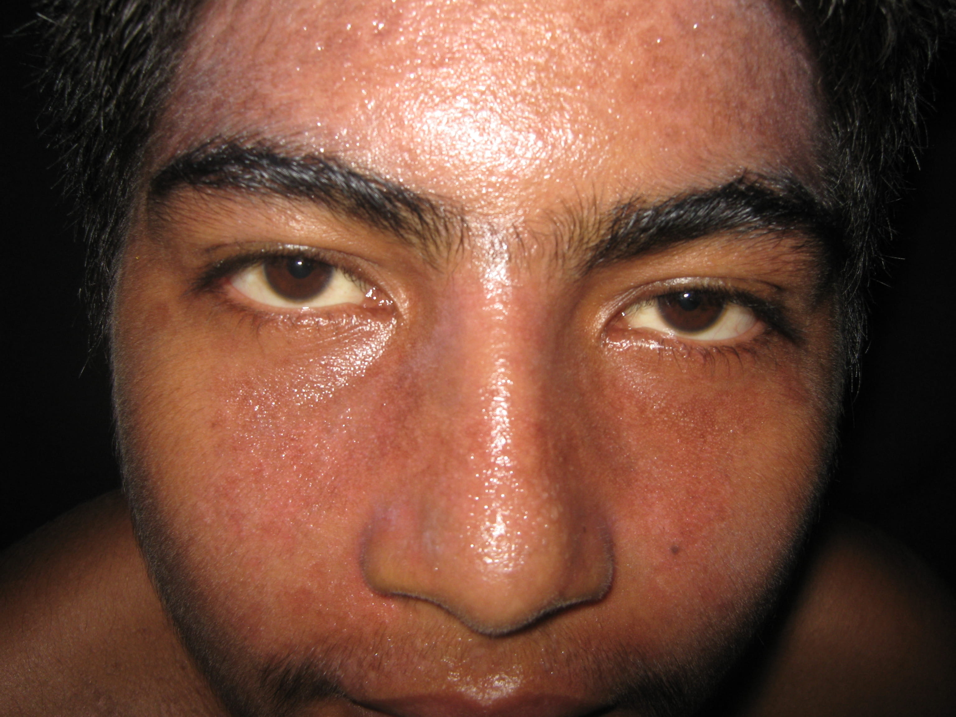 IMPETIGO - Enfermedad de Darier