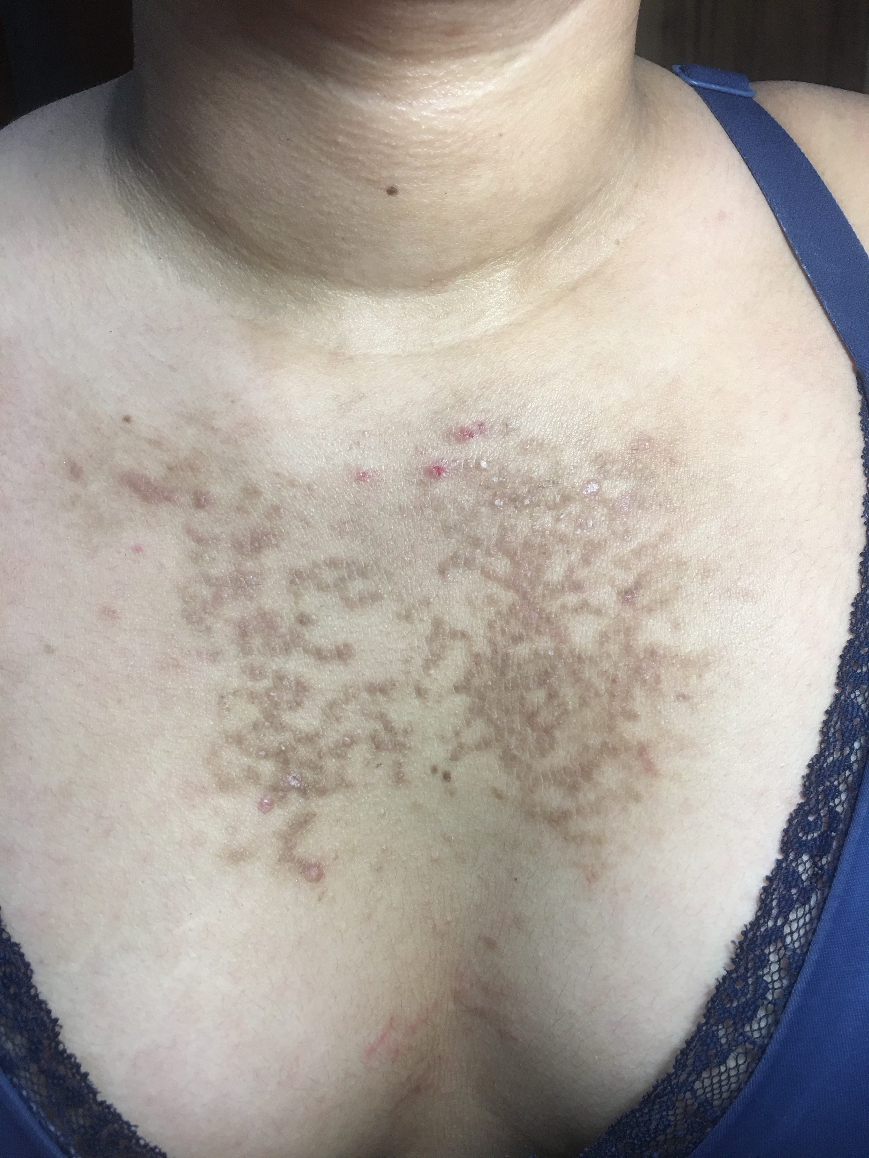 PAPULOMATOSIS CONFLUENTE Y RETICULADA