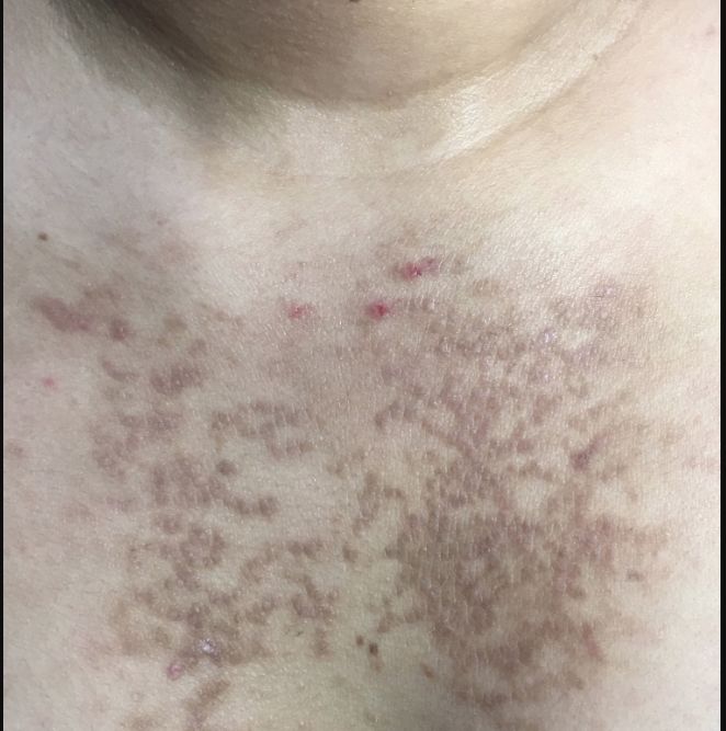 PAPULOMATOSIS CONFLUENTE Y RETICULADA