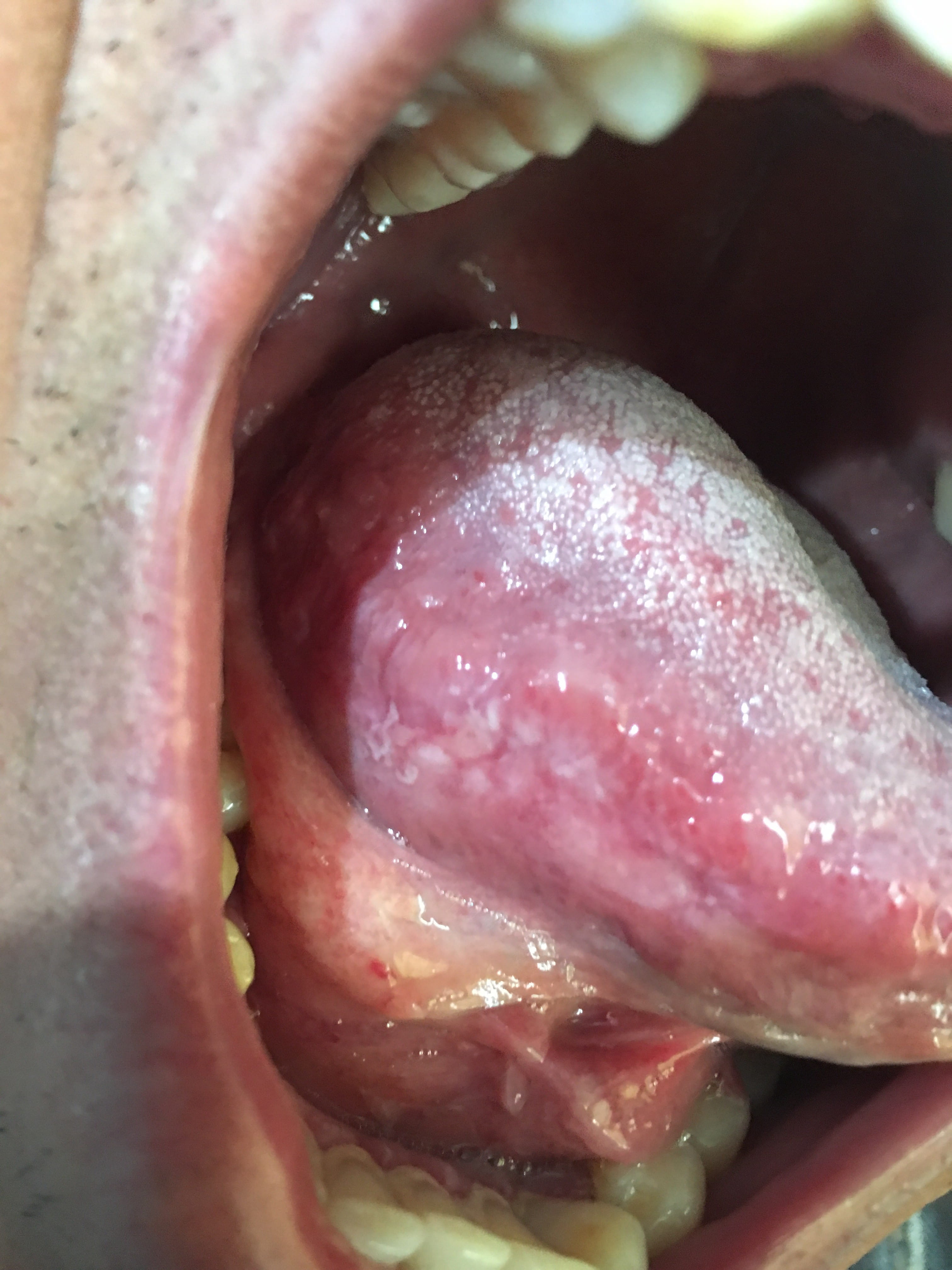 LEUCOPLASIA DE LA LENGUA