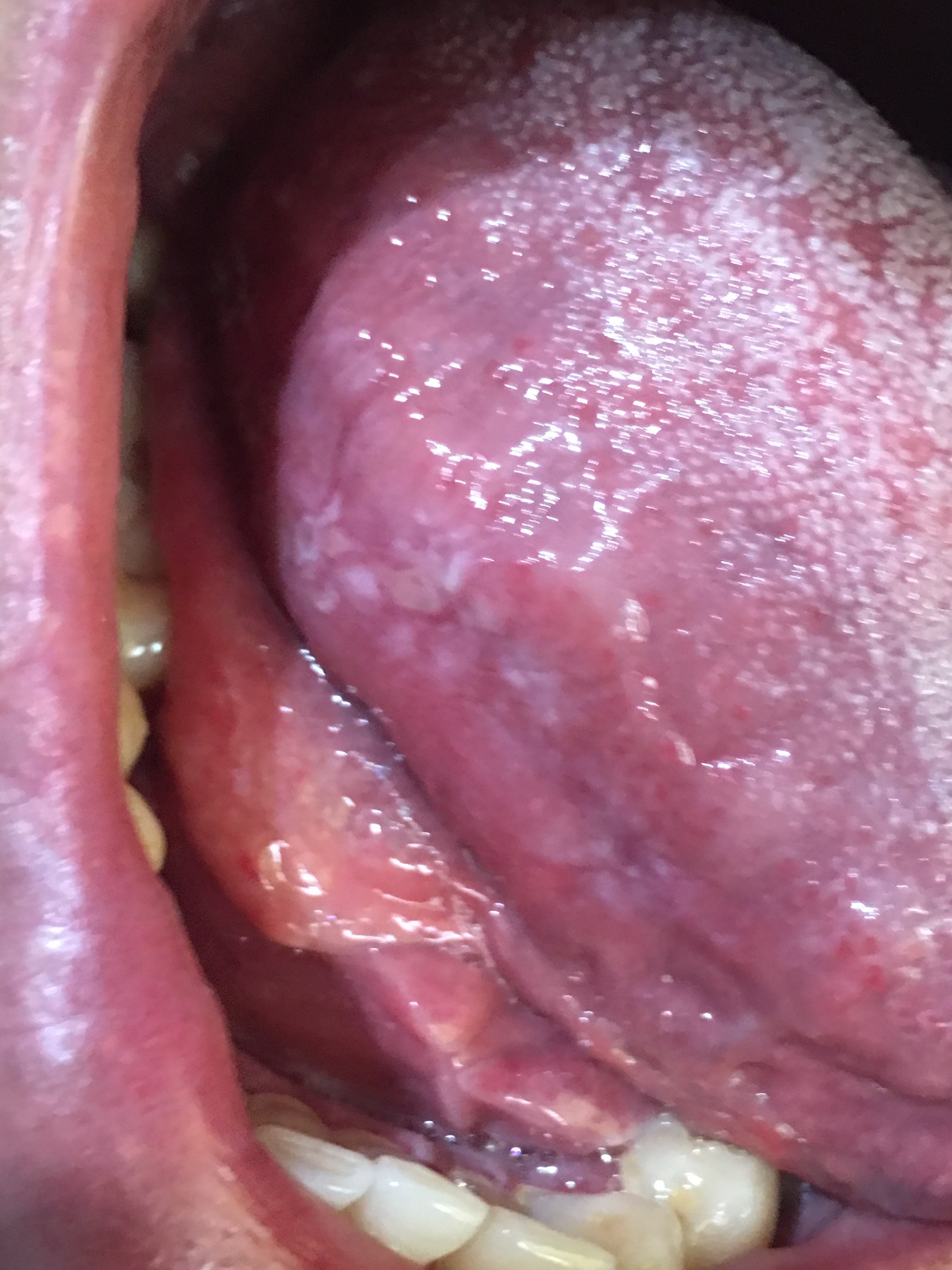 LEUCOPLASIA DE LA LENGUA