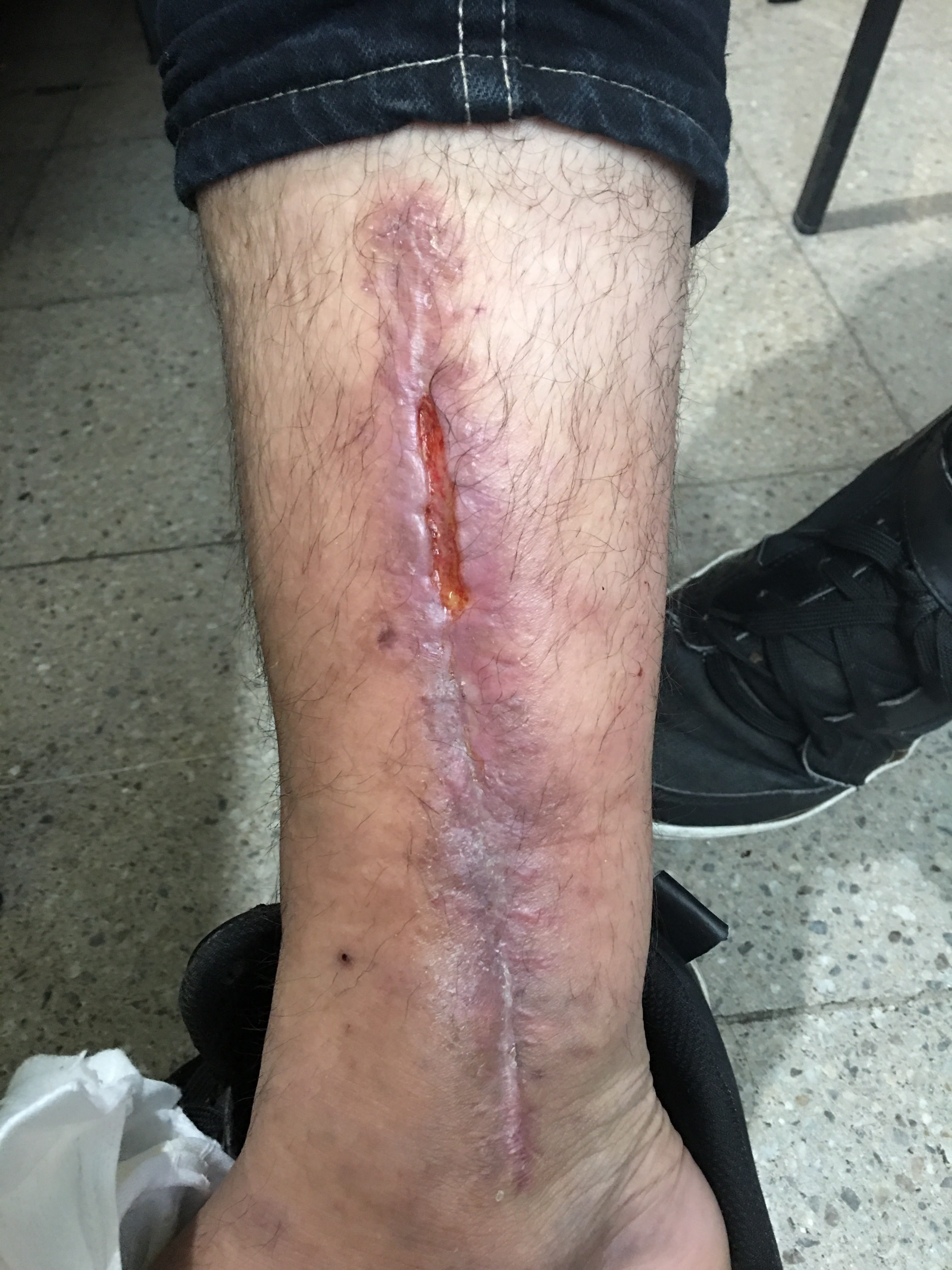 ULCERA POST OPERATORIA