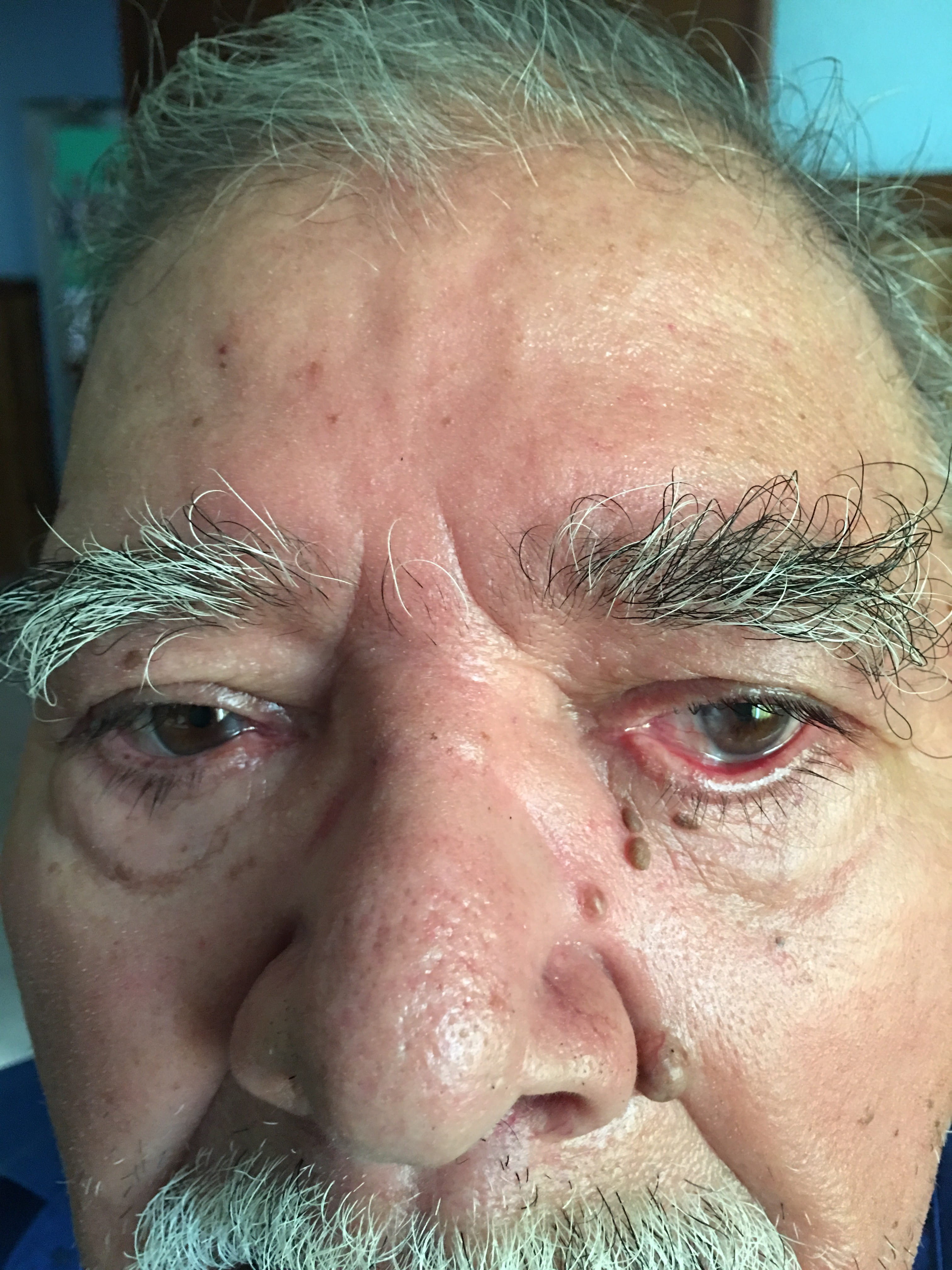 QUERATOSIS SEBORREICA - Ectoprion