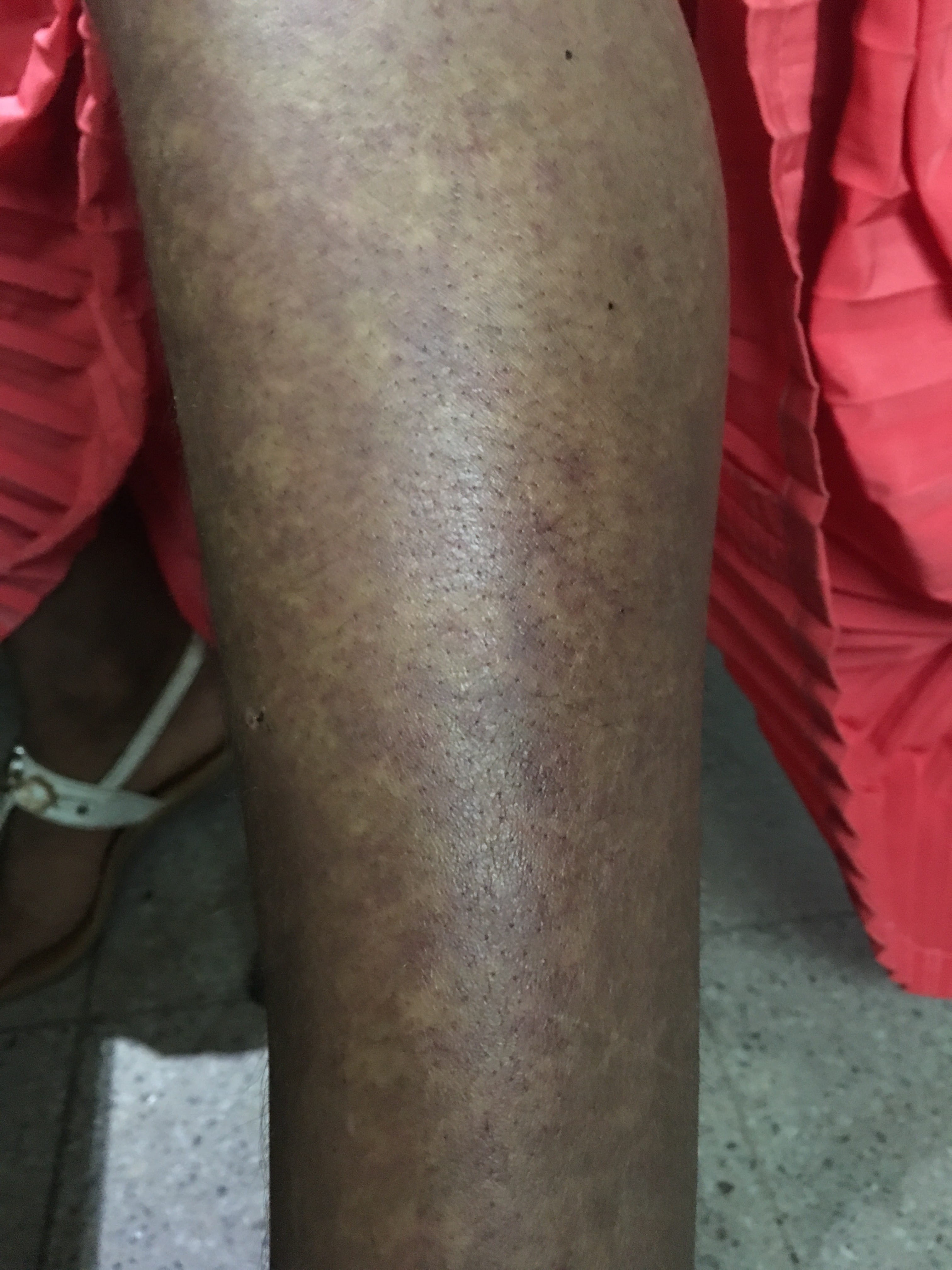 HIPERCROMIA POST INFLAMATORIA