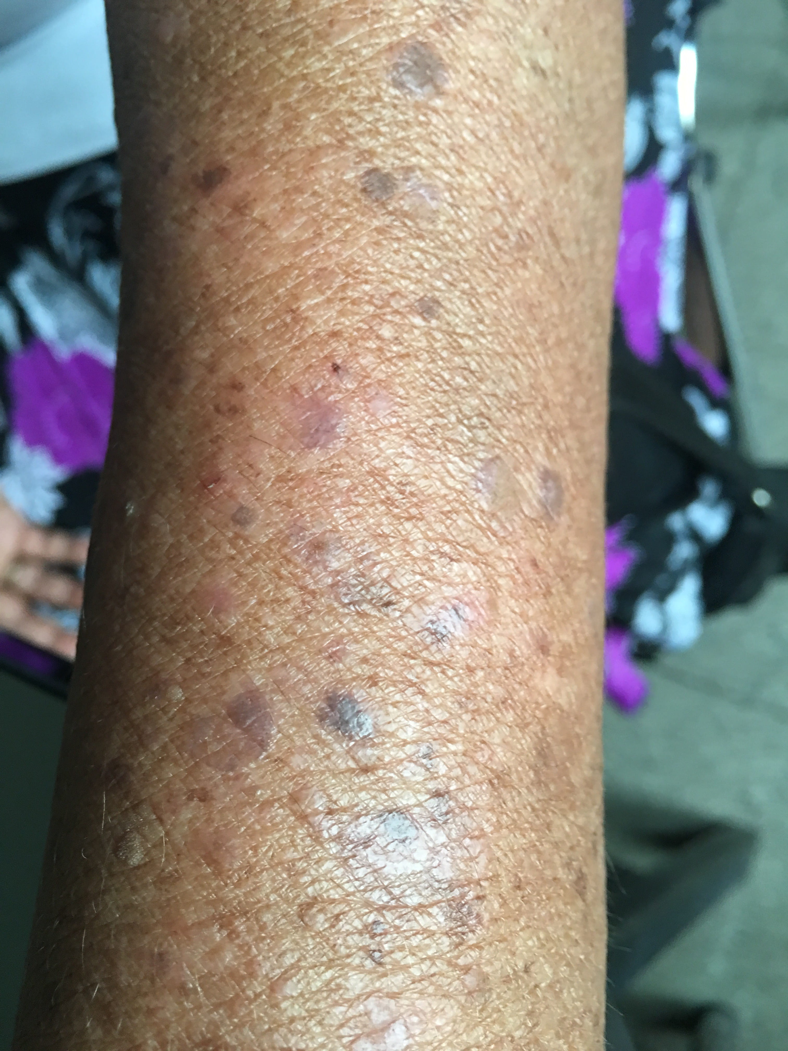 DERMOPATIA SOLAR CRONICA