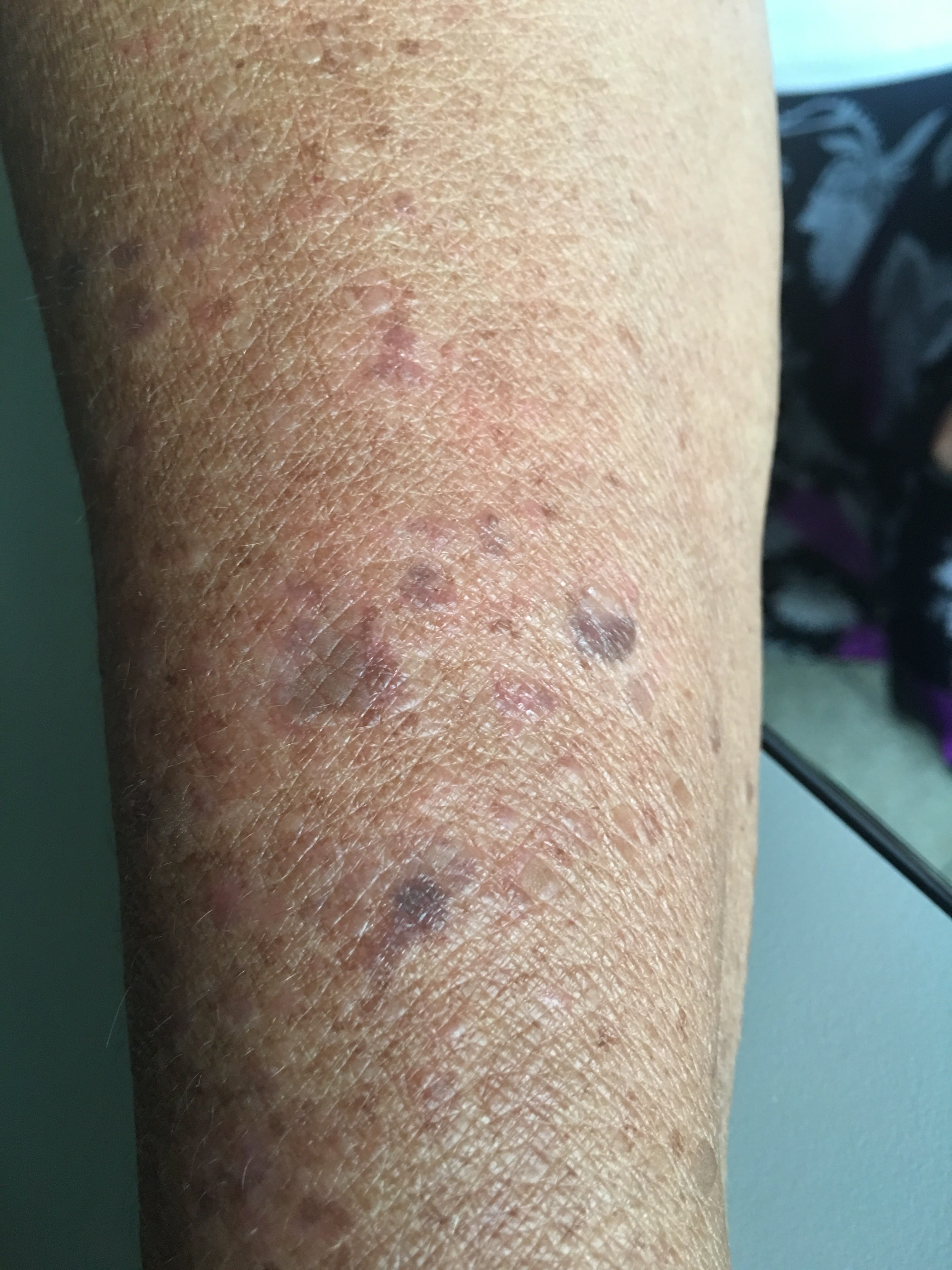 DERMOPATIA SOLAR CRONICA