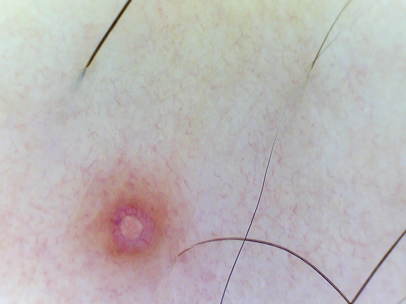 MOLUSCO CONTAGIOSO