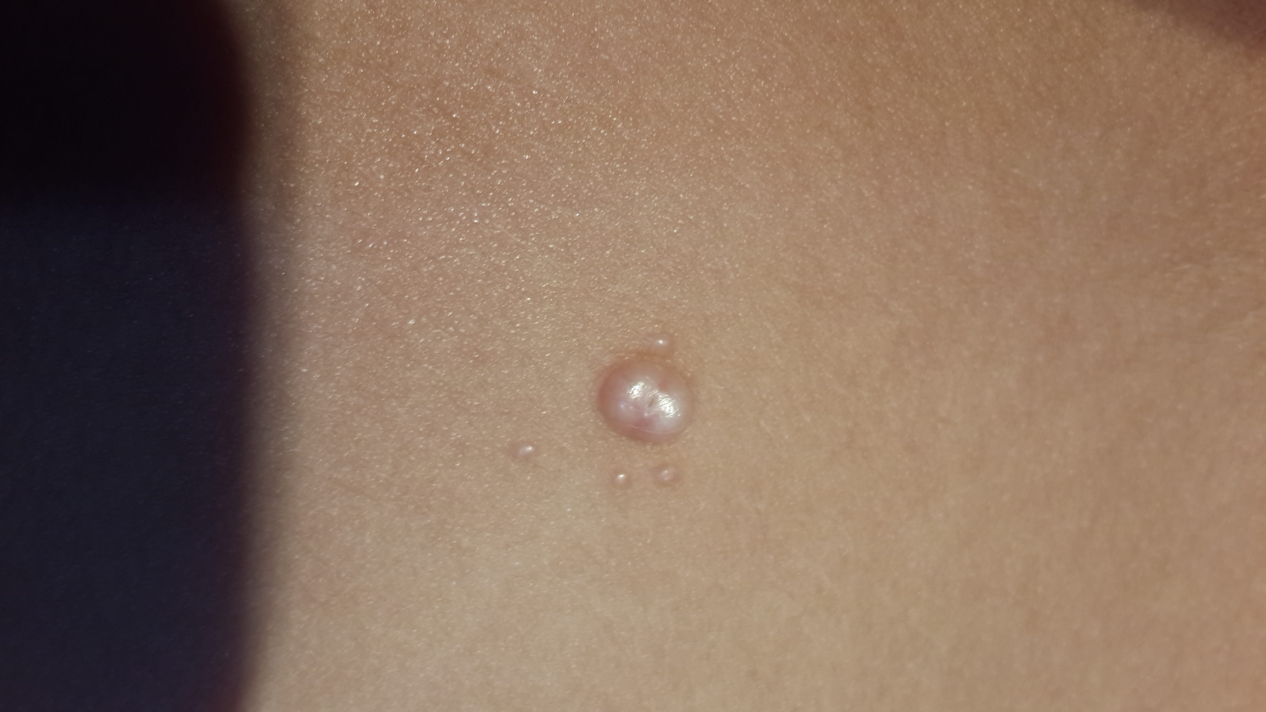 MOLUSCO CONTAGIOSO