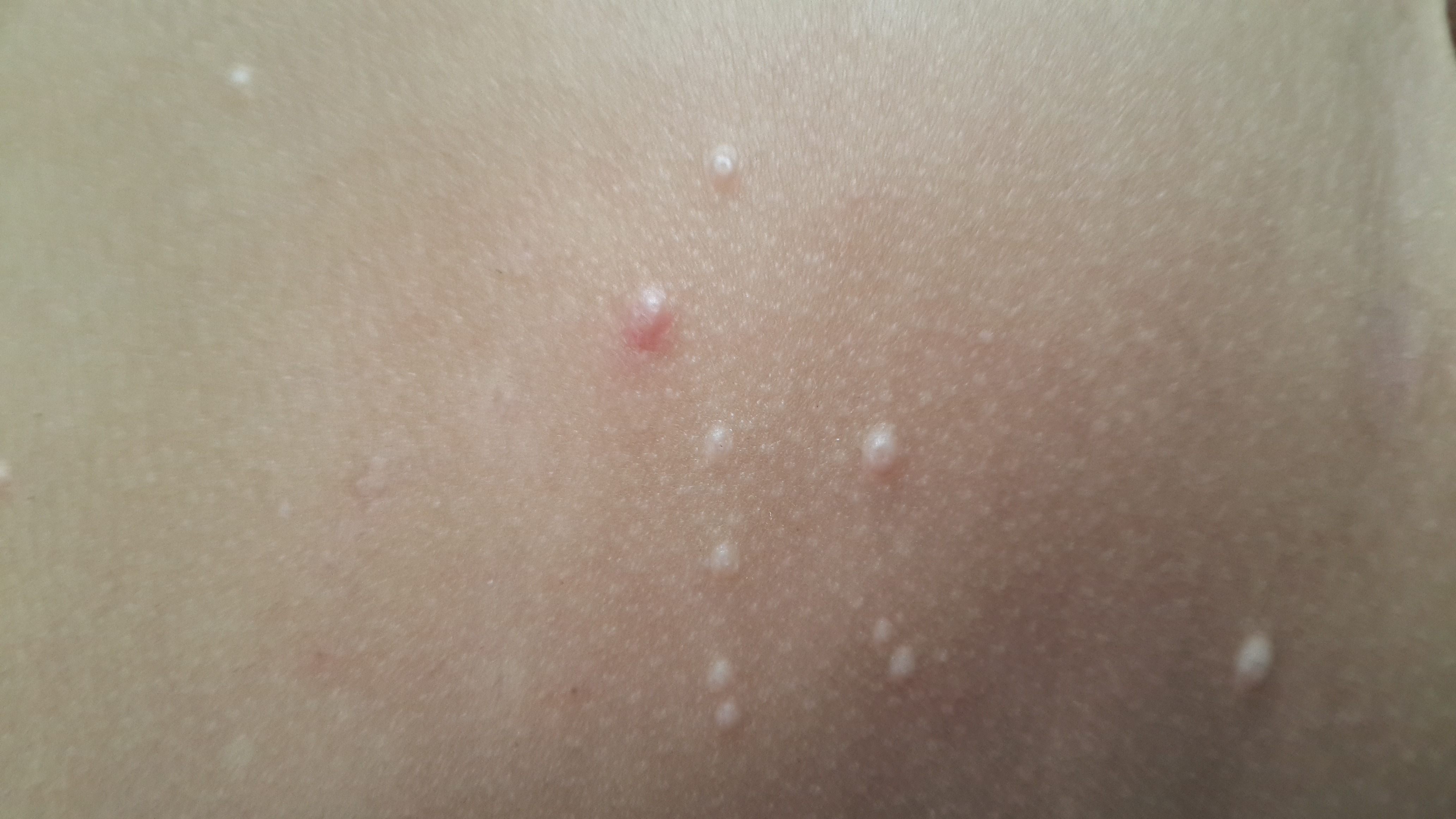 MOLUSCO CONTAGIOSO