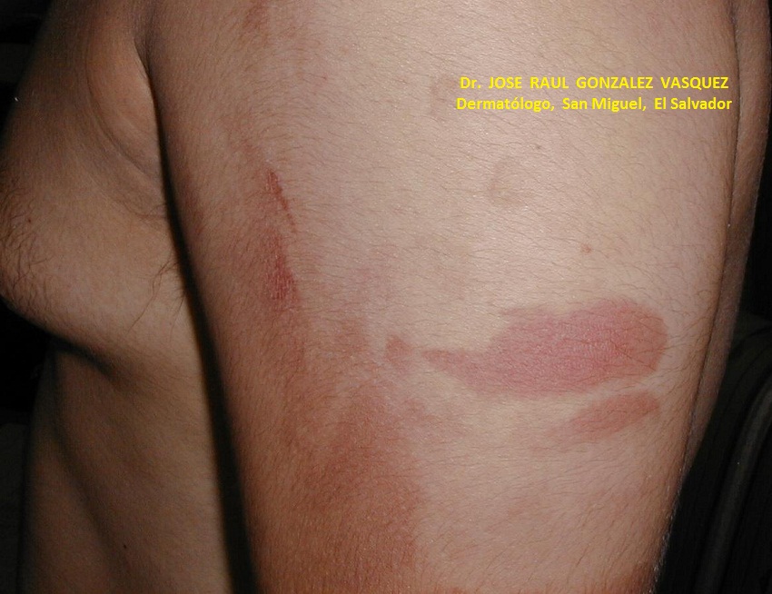 FITOFOTODERMATITIS - Furocumarinas