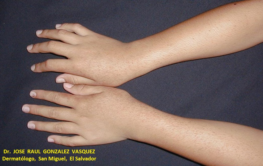 FITOFOTODERMATITIS - Furocumarinas