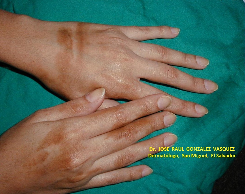 FITOFOTODERMATITIS - Furocumarinas