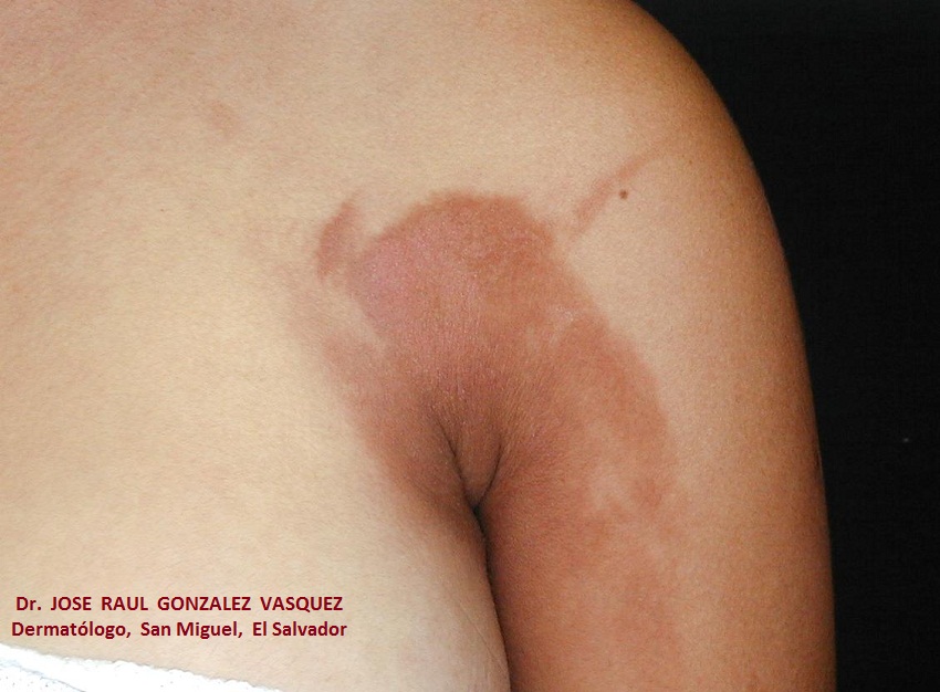 FOTODERMATITIS -  por desodorante