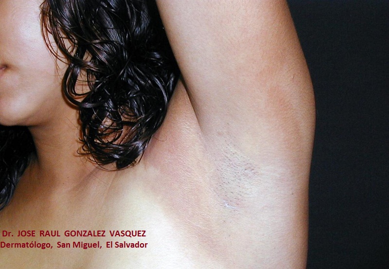FOTODERMATITIS -  por desodorante